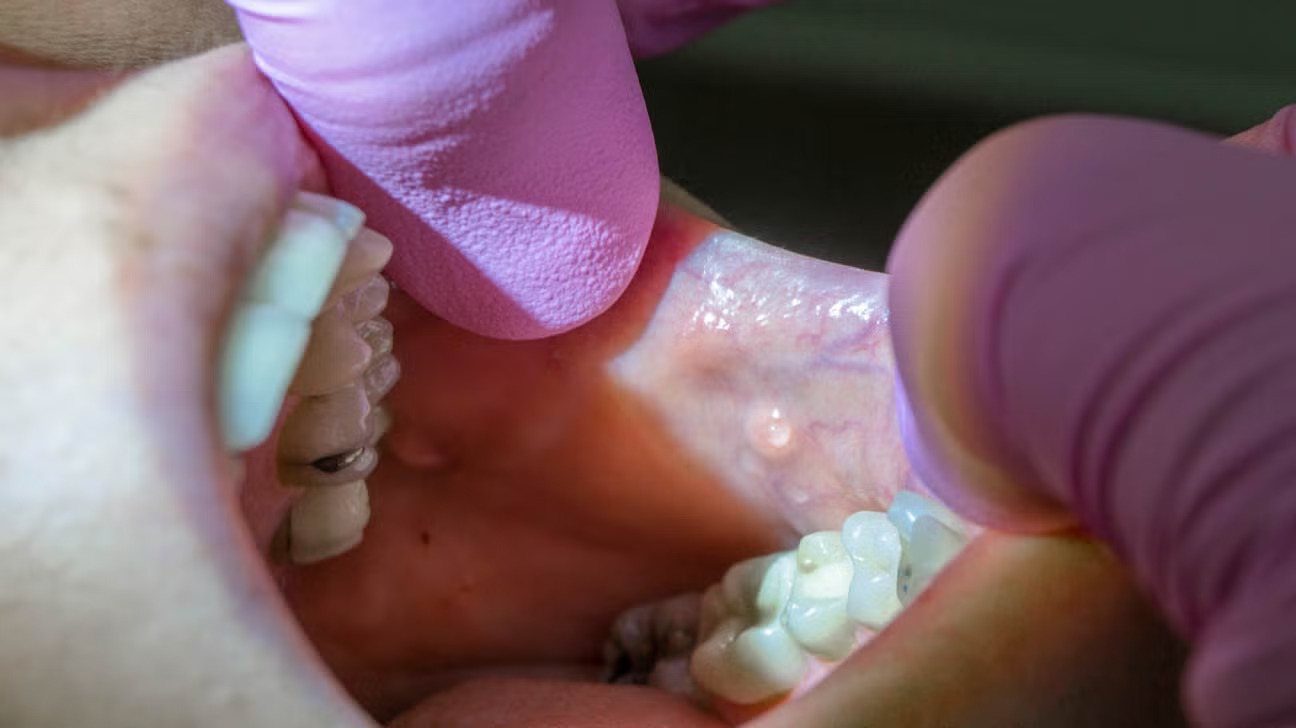 Sưng tuyến nước bọt sẽ gây giảm tiết nước bọt ở người bị bệnh