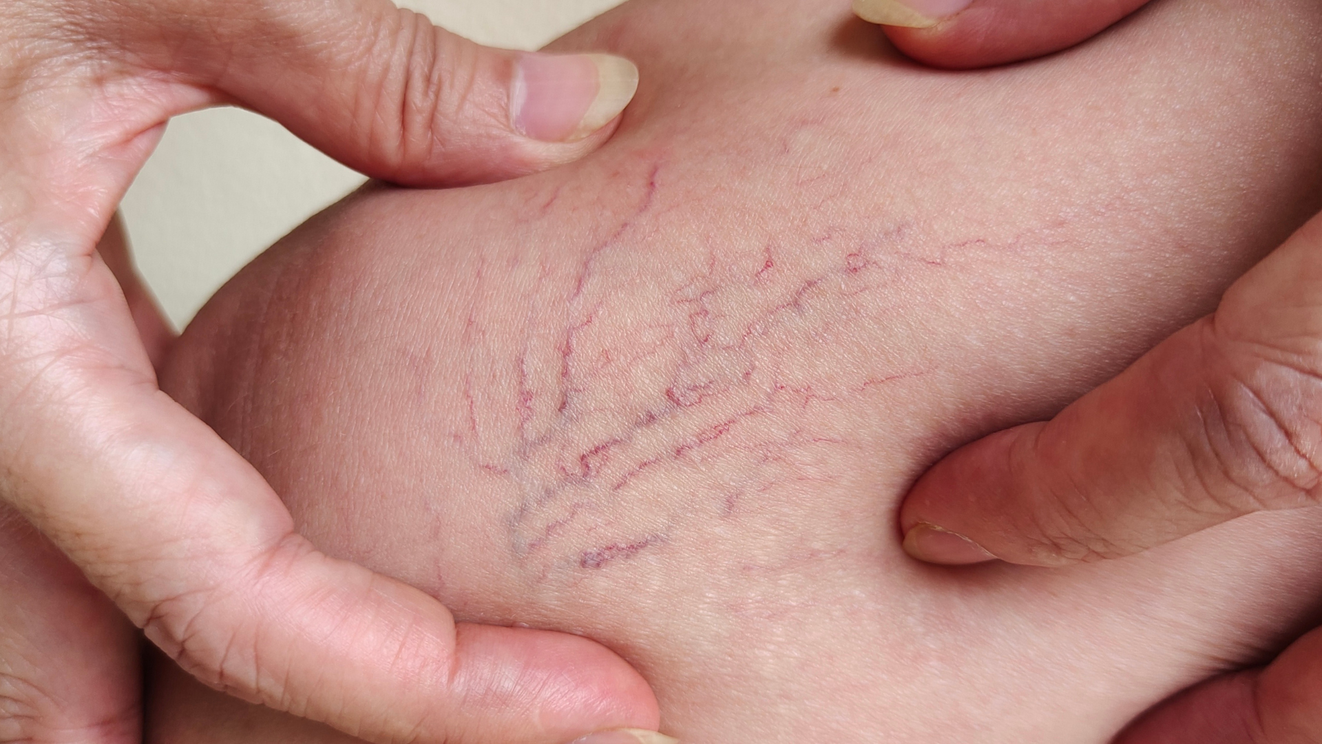 Giải đáp thắc mắc về suy giãn tĩnh mạch kiêng ăn gì và nên ăn gì?