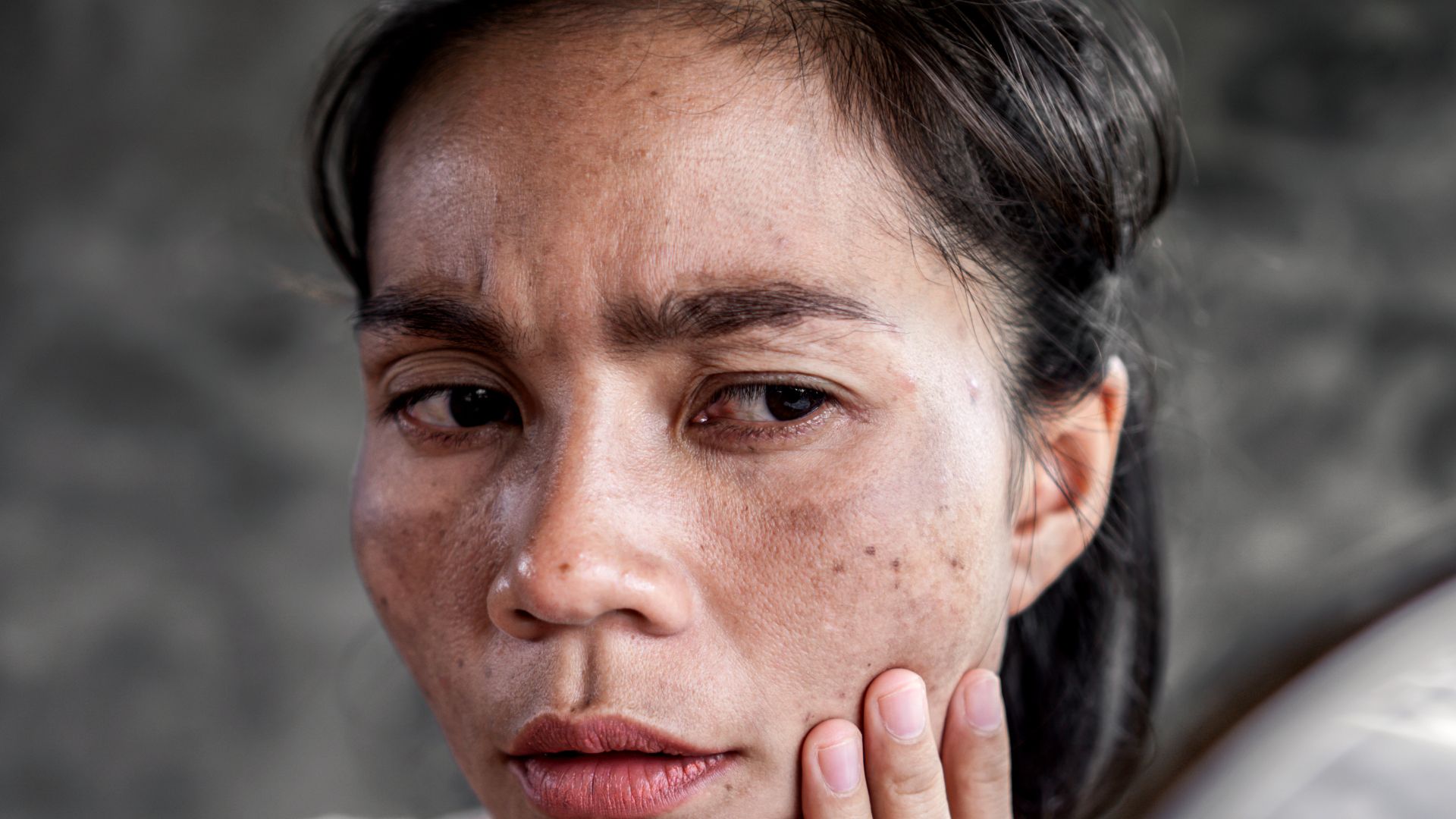 Suy thận độ 4: Dấu hiệu, tiên lượng sống và các biện pháp hỗ trợ 3