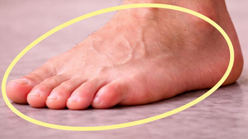 Suy van tĩnh mạch chi dưới gây cảm giác nặng chân, sưng phù và nổi gân xanh đặc trưng