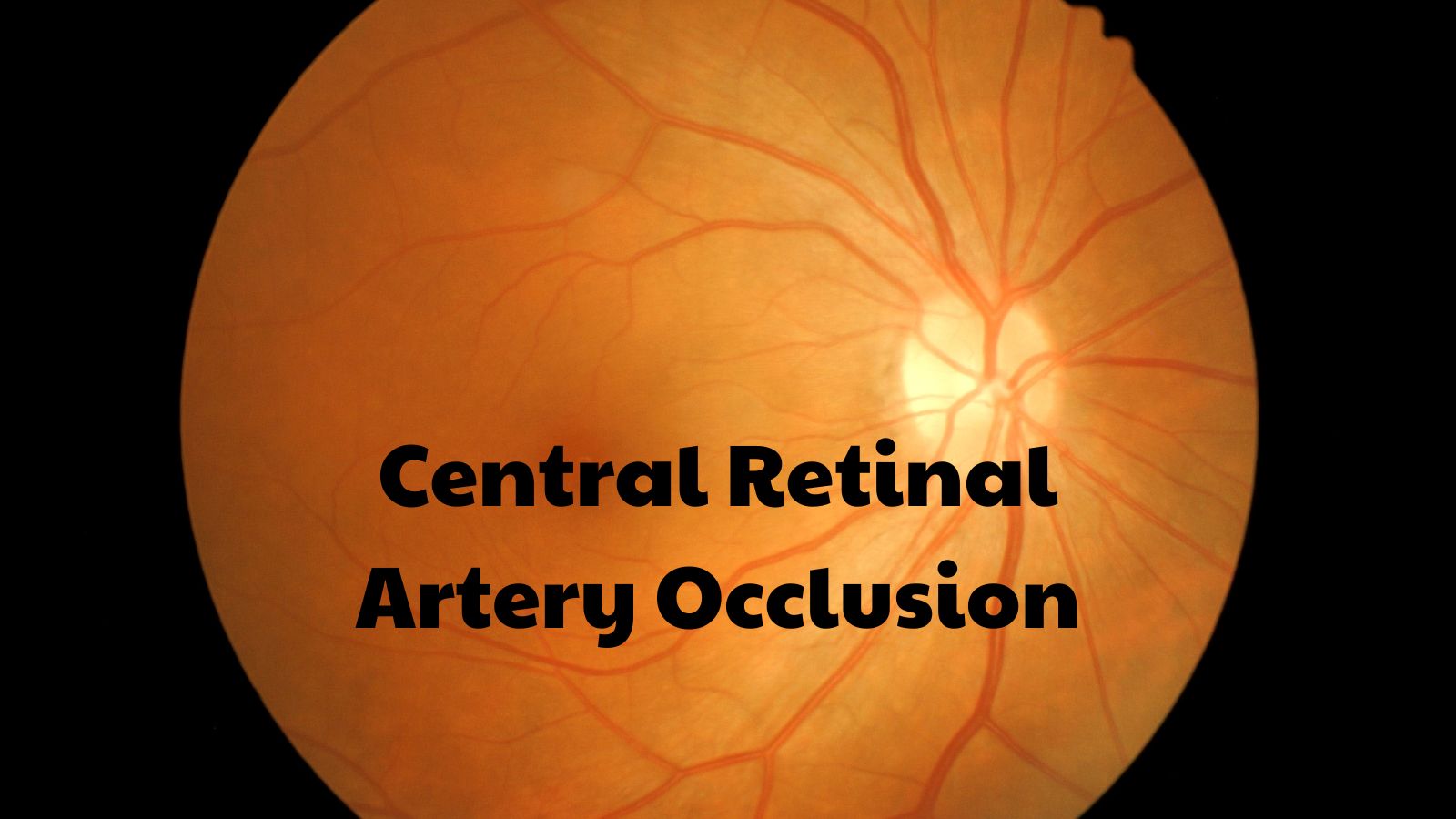 Tắc động mạch trung tâm võng mạc được xem là một thể đột quỵ thiếu máu cục bộ cấp tại mắt