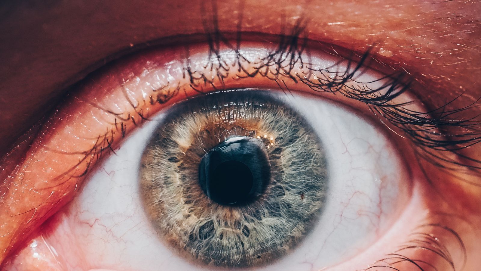 Chứng mù thoáng qua (do co thắt động mạch) xuất hiện đột ngột với biểu hiện mất thị lực hoàn toàn ở một mắt