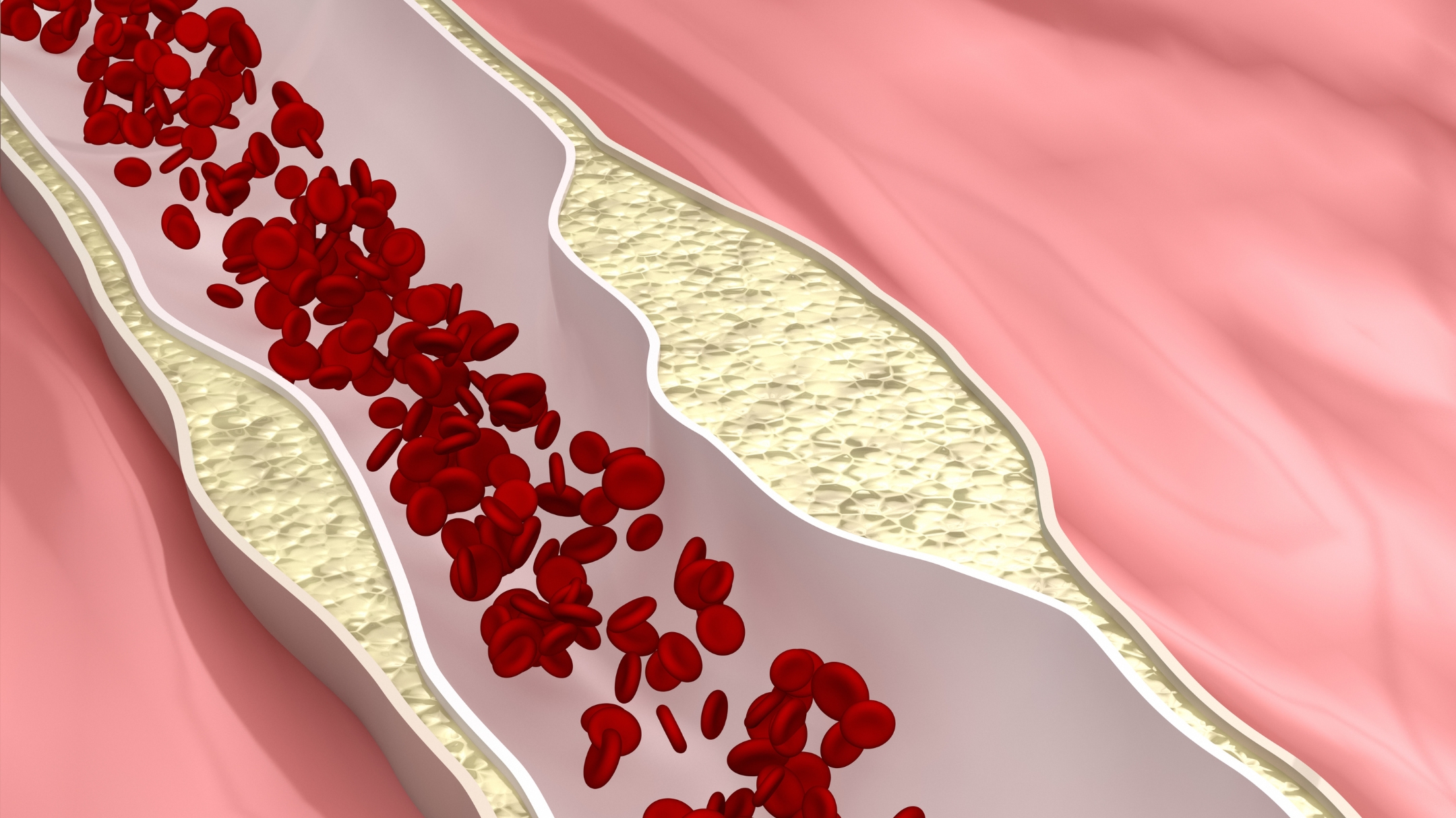 Mỡ nội tạng làm tăng viêm mạch máu và rối loạn lipid máu, gây hình thành mảng xơ vữa trong lòng mạch, cản trở lưu thông máu