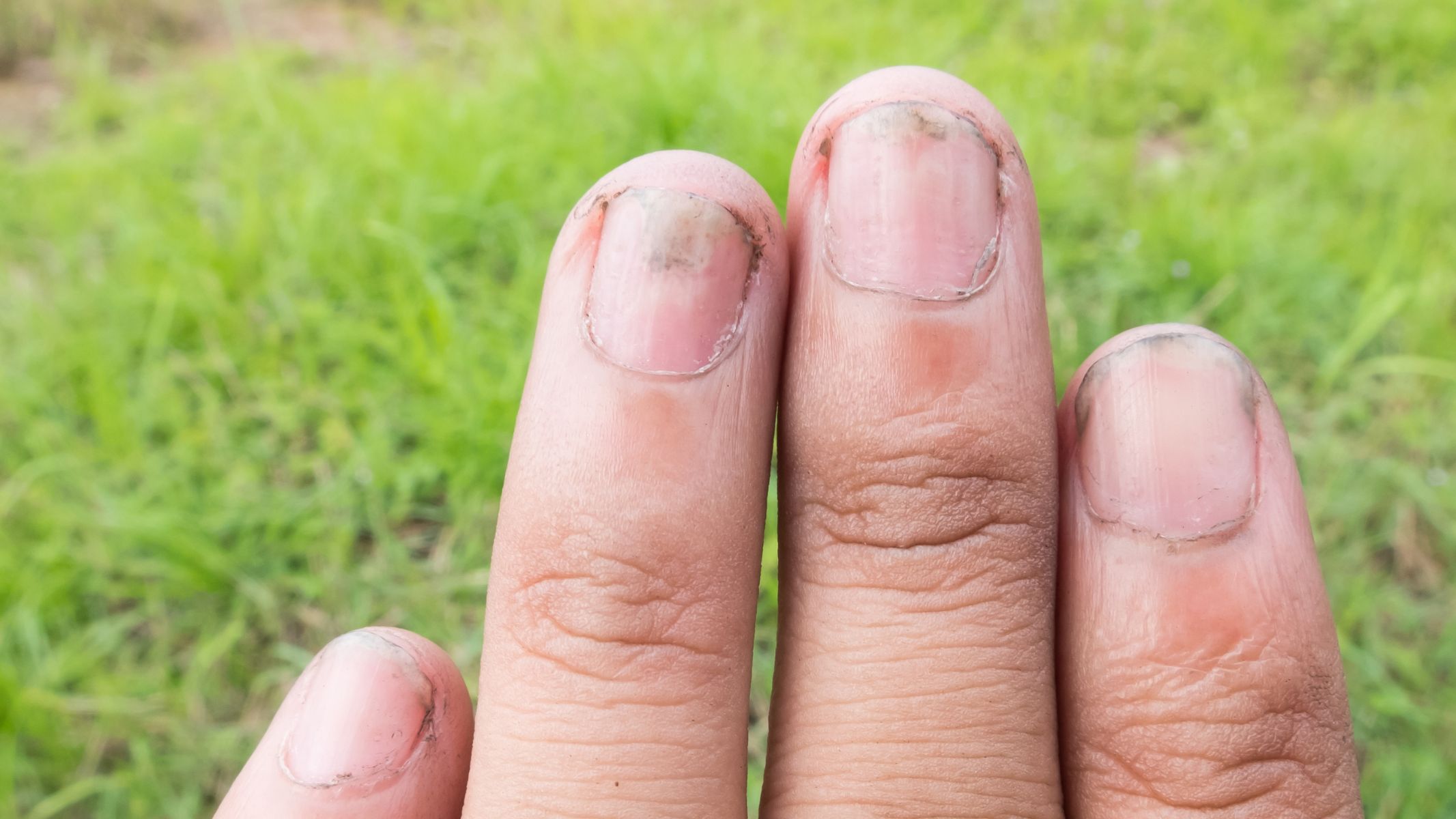 Tác hại của việc cắn móng tay: Nguy hiểm tiềm ẩn đối với sức khỏe 2
