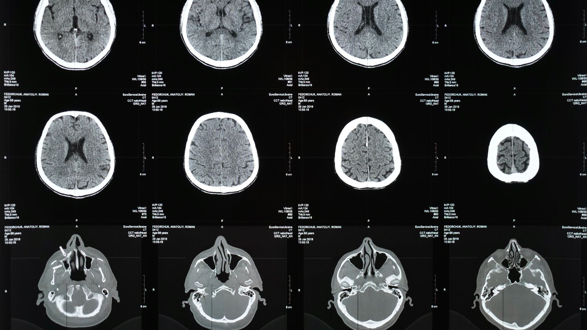 CT Scan sọ não là cận lâm sàng hình ảnh quan trọng giúp chẩn đoán bệnh đột quỵ
