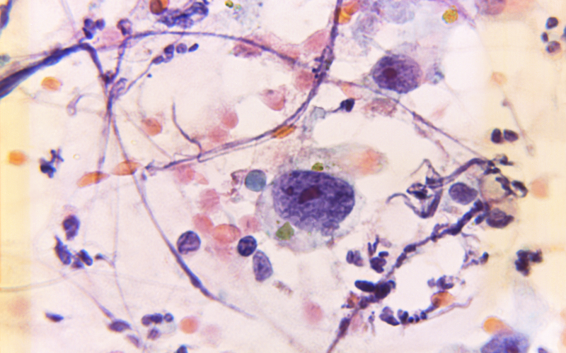 tai-sao-bach-cau-lympho-giam-cach-khac-phuc-hieu-qua-4