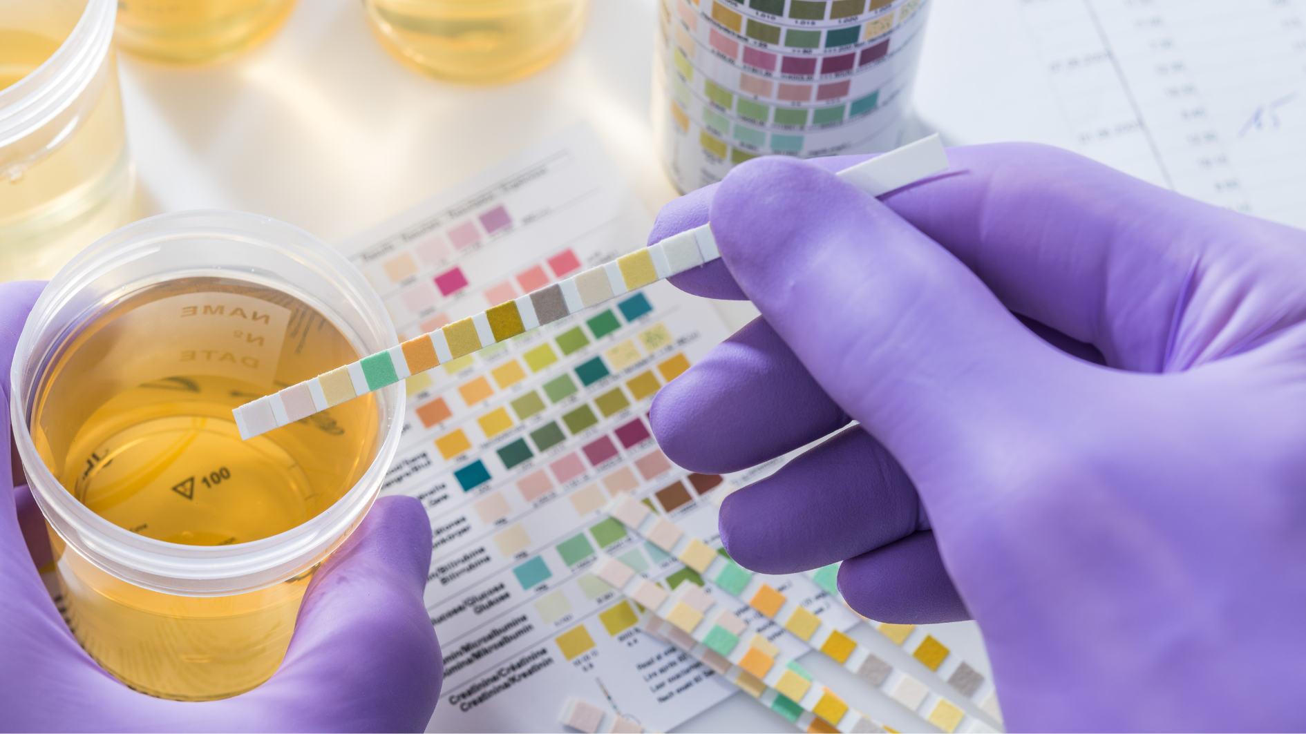 Xét nghiệm cấy nước tiểu tìm nguyên nhân tình trạng nước tiểu đỏ như màu trà