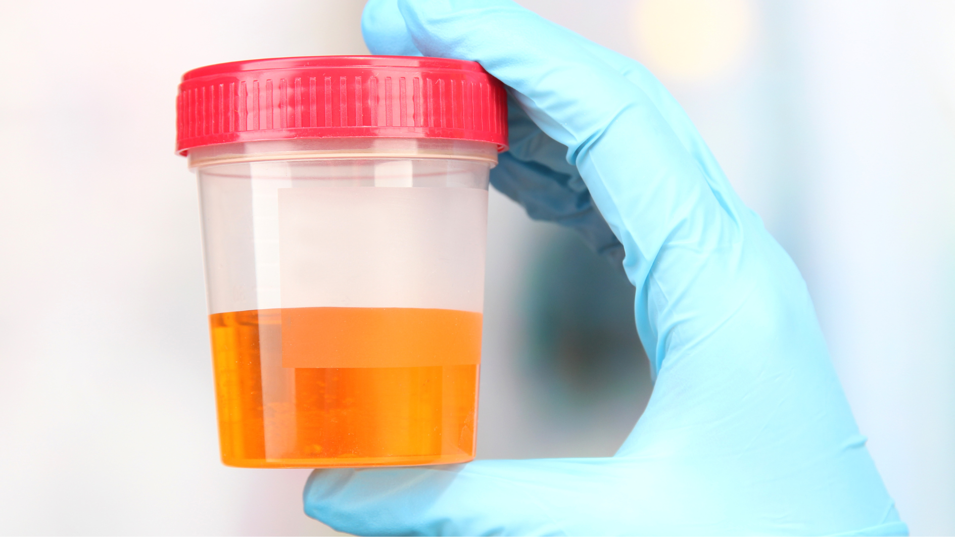 Nước tiểu màu vàng sẫm có thể do bé thiếu nước