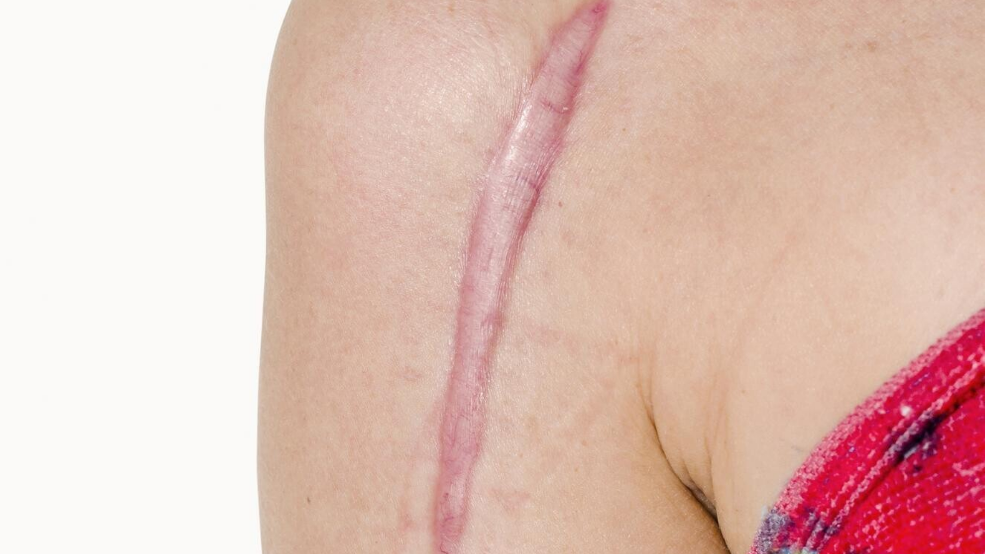 Đối với một số người thì lượng collagen sản sinh quá mức có thể dẫn đến sẹo lồi hoặc phì đại
