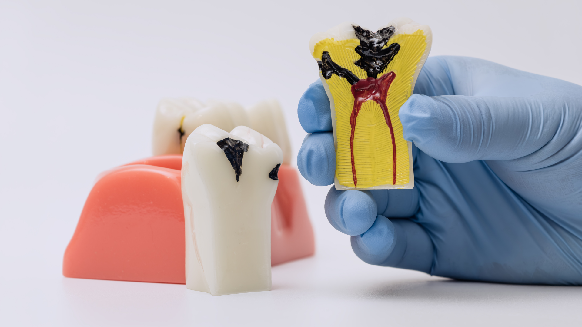 Viêm tuỷ răng làm đau răng ban đêm nghiêm trọng hơn