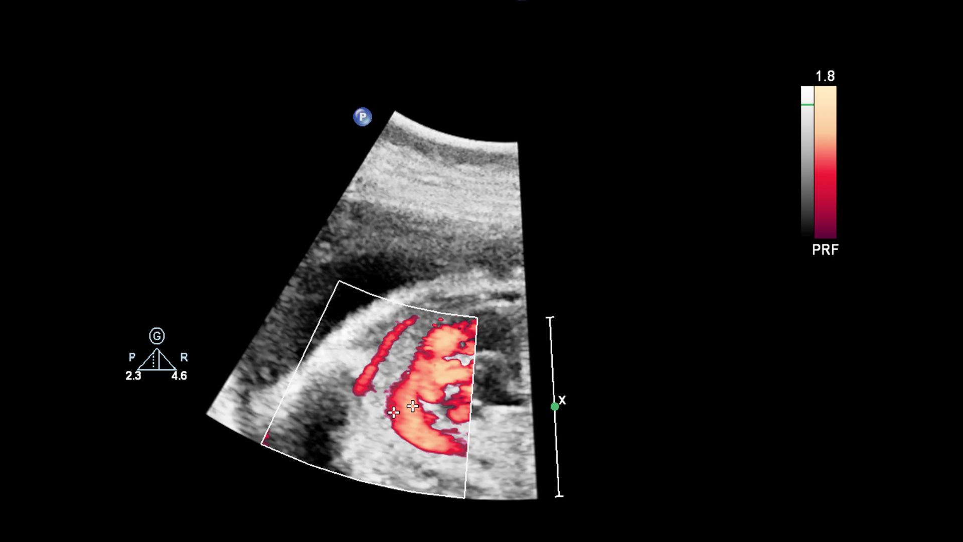 Tại sao thai nhi bị thận ứ nước là thắc mắc của nhiều phụ huynh