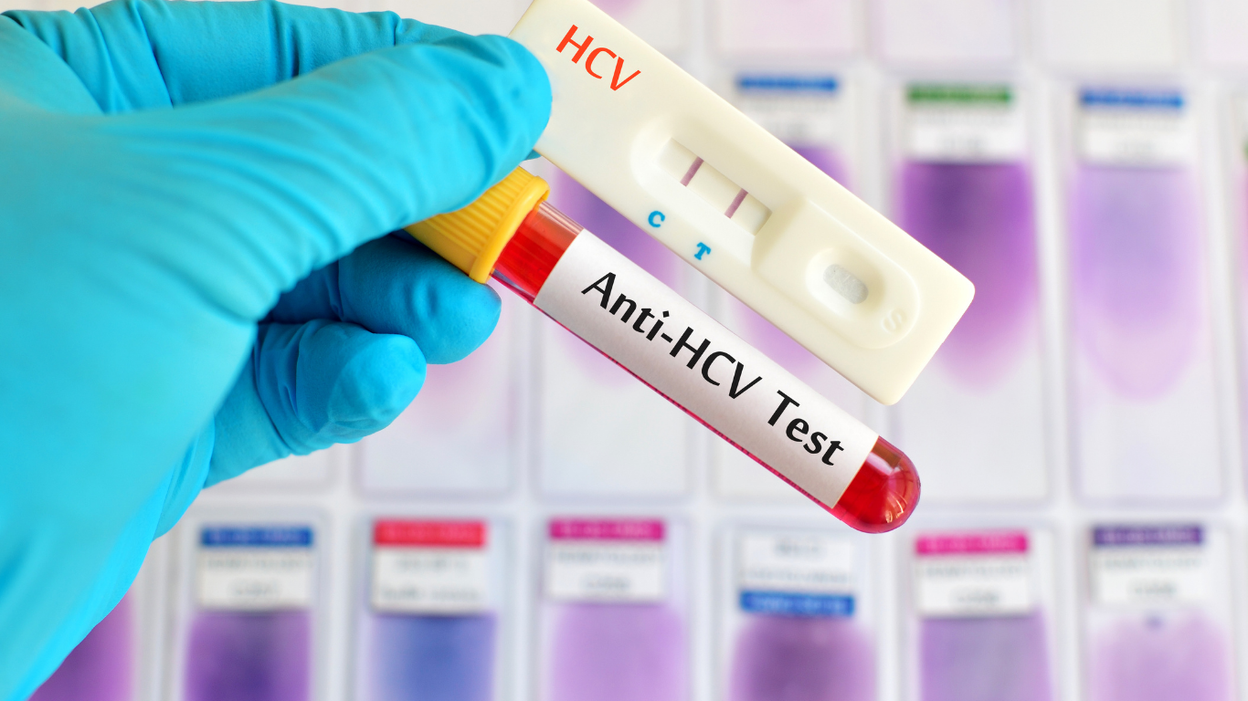 Xét nghiệm HCV Ab miễn dịch tự động là phương pháp phát hiện sự hiện diện của kháng thể kháng HCV trong máu