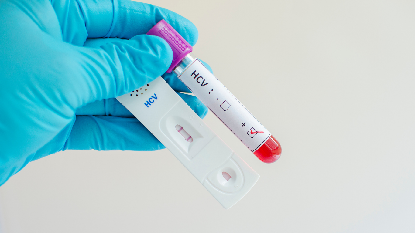 Kết quả xét nghiệm HCV Ab miễn dịch tự động có hai dạng chính là dương tính và âm tính