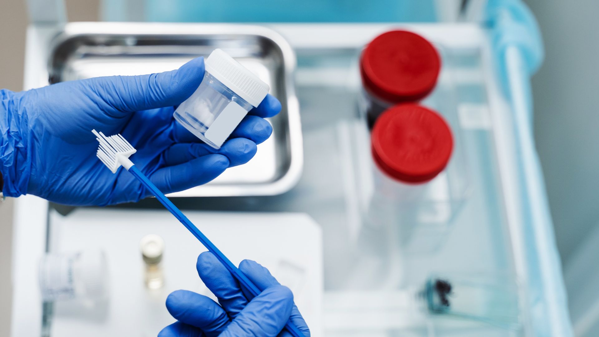 Xét nghiệm tế bào học hậu môn, tương tự Pap smear ở cổ tử cung, giúp phát hiện tế bào bất thường