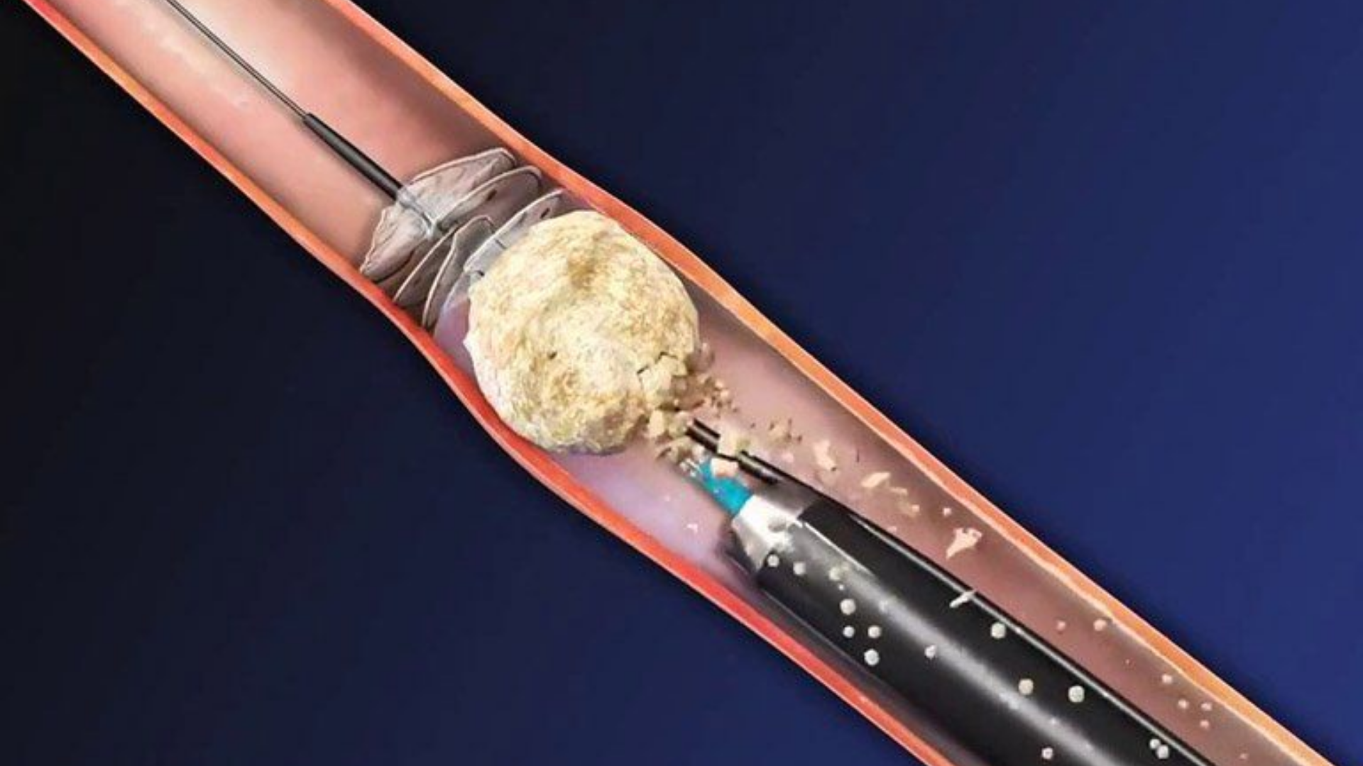 Tán sỏi niệu quản sử dụng năng lượng cao từ laser hoặc sóng xung kích để phá vỡ viên sỏi