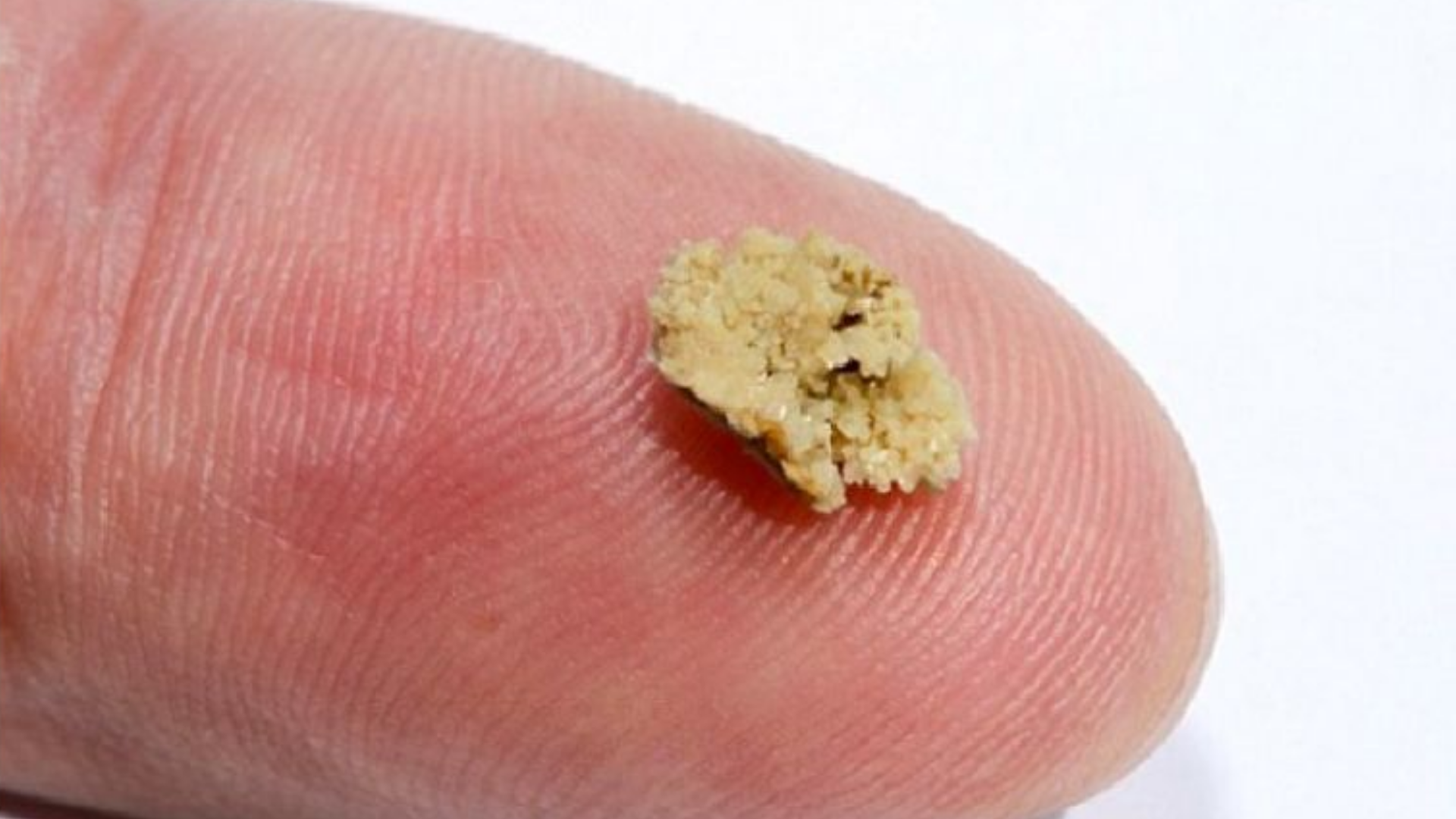 Bác sĩ thường chỉ định tán sỏi niệu quản khi viên sỏi có kích thước từ 6mm đến dưới 2cm và gây triệu chứng rõ rệt