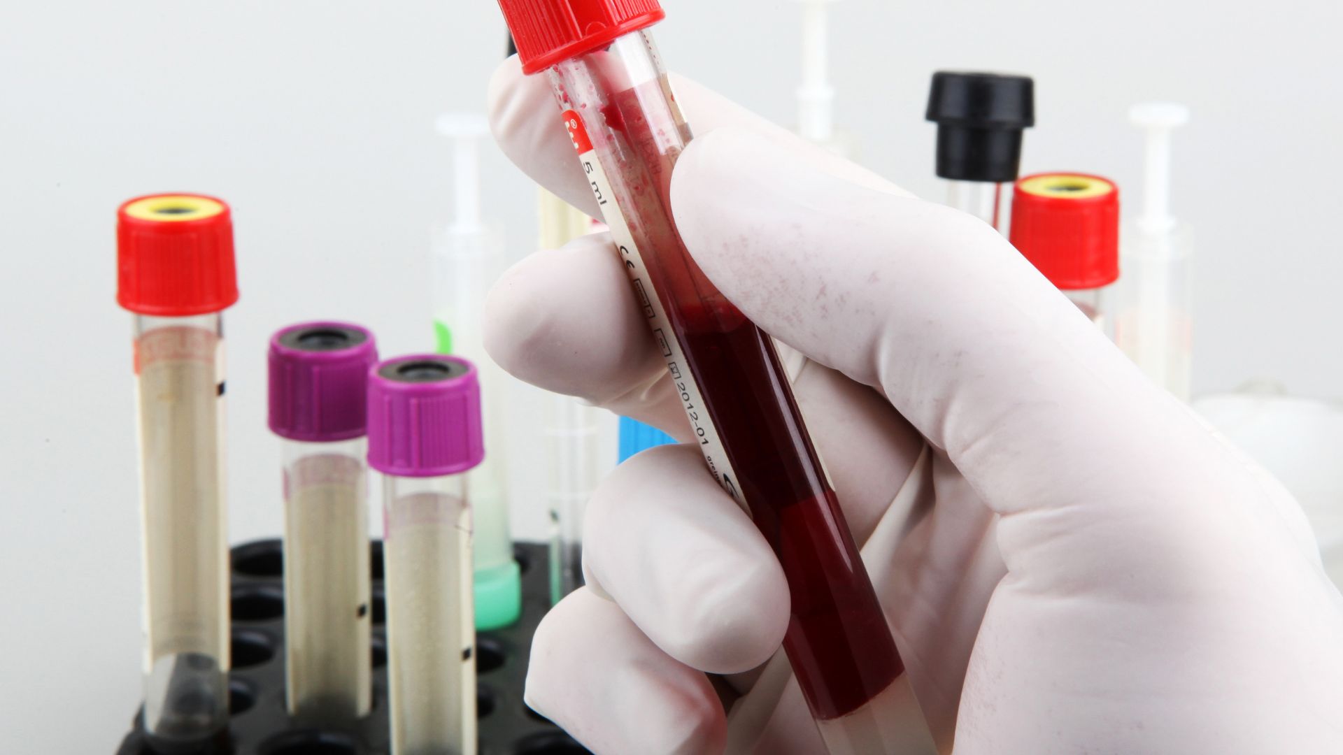 Xét nghiệm máu giúp đo số lượng và tỷ lệ của từng loại bạch cầu trong chẩn đoán bệnh