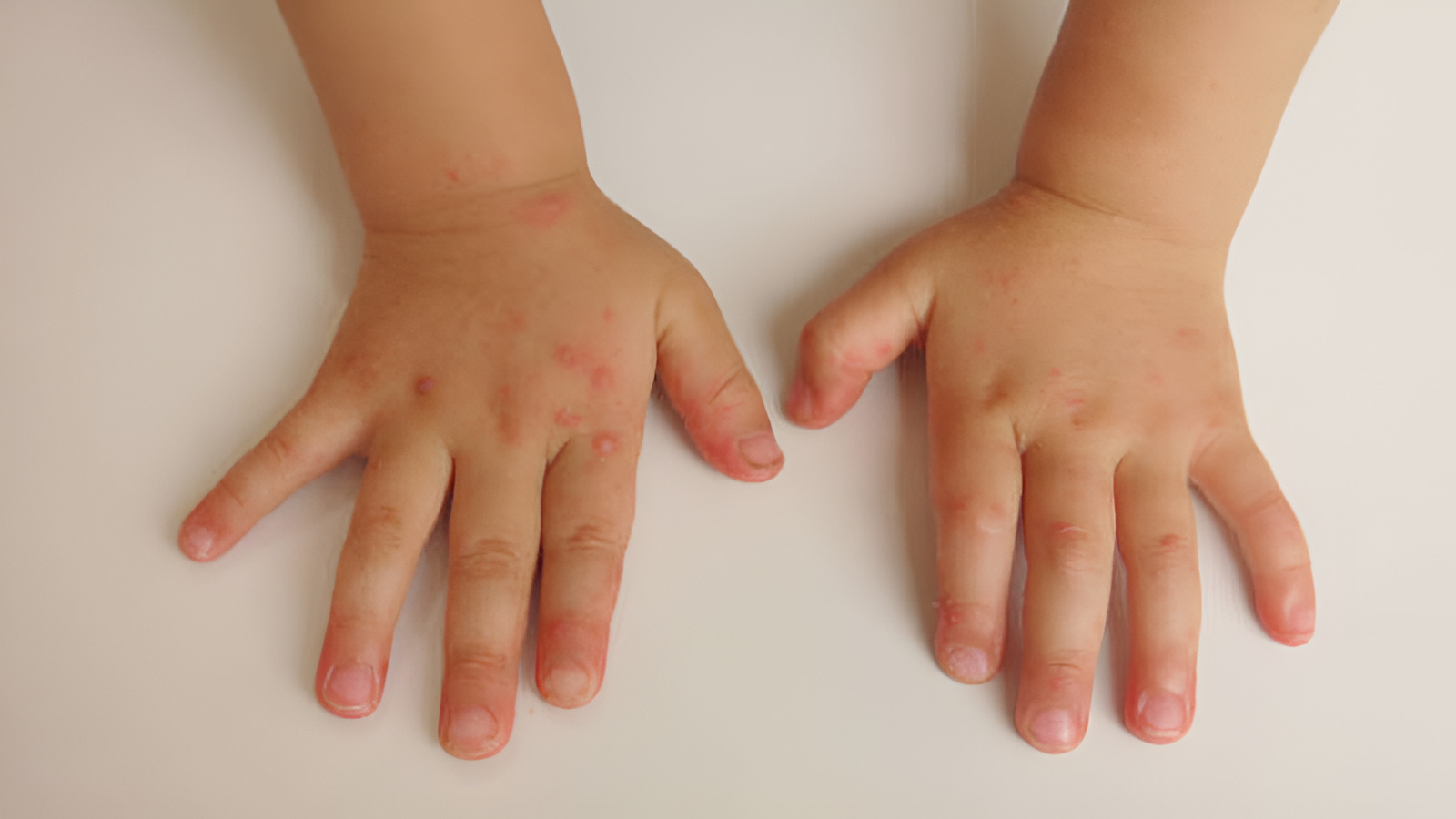 Tay chân miệng độ 1 mấy ngày thì khỏi? Dấu hiệu và cách chăm sóc sức khỏe an toàn 2