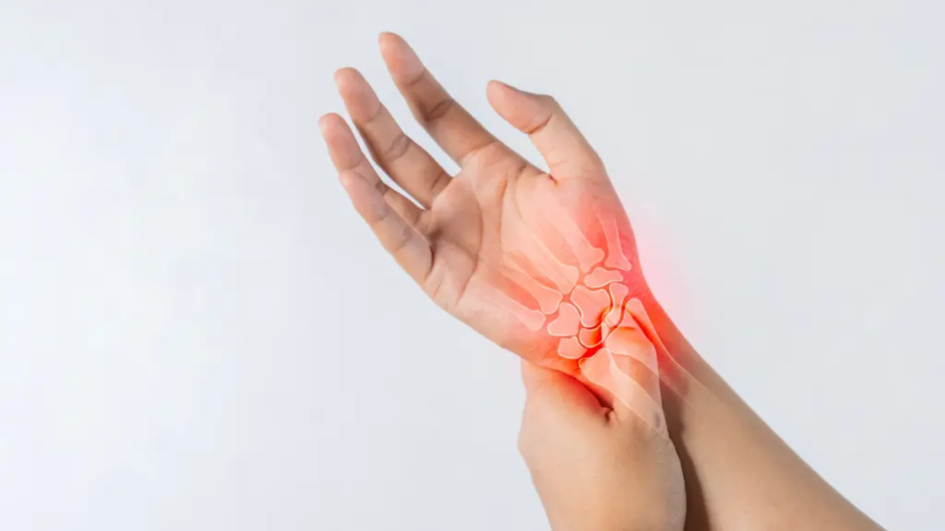 Hội chứng ống cổ tay xảy ra khi dây thần kinh giữa bị chèn ép trong ống cổ tay, gây ra cảm giác tê và đau ở vùng ngón tay