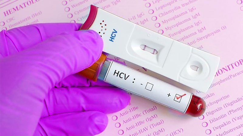 Xét nghiệm anti-HCV giúp chẩn đoán virus HCV có trong máu