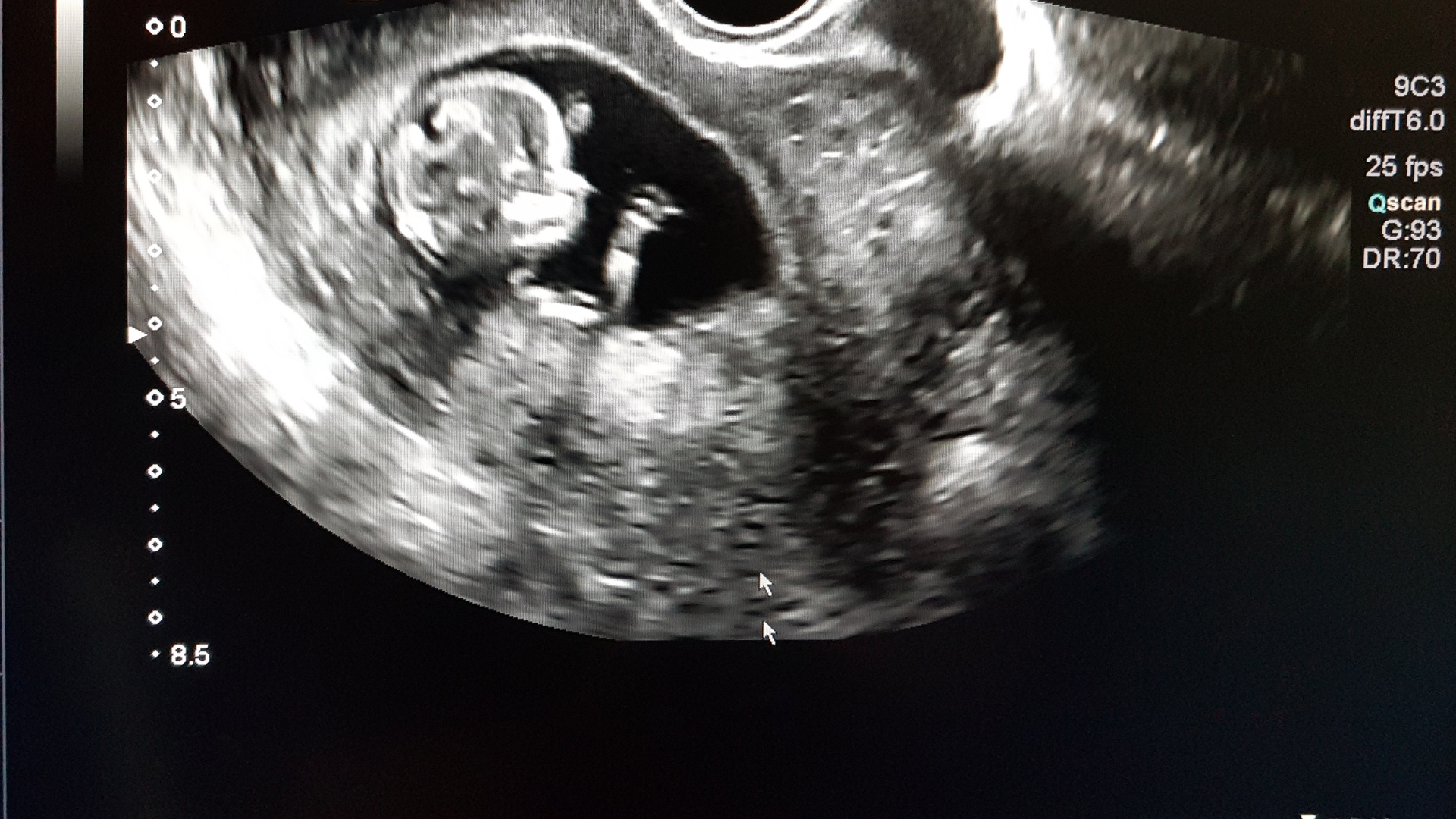 Một số nguyên nhân có thể ảnh hưởng đến tốc độ phát triển của thai trong những tuần đầu