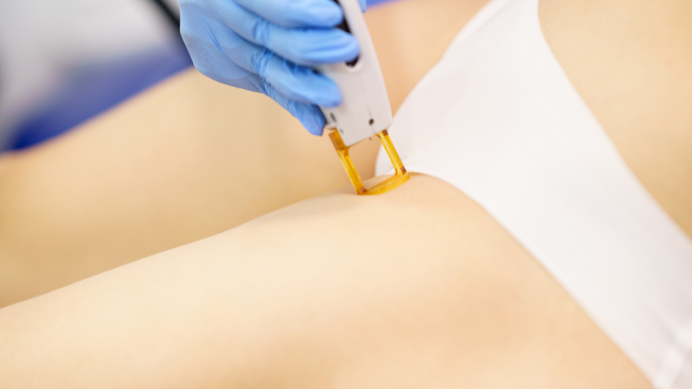 Trị thâm bẹn bằng kem dưỡng và thói quen đúng cách