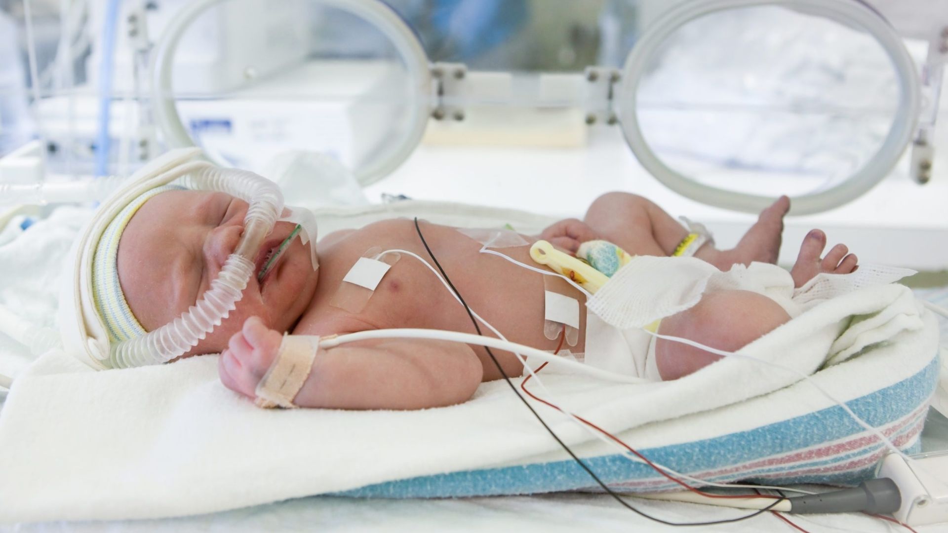 Trẻ mắc thận đa nang cần được thở máy ngay khi chào đời