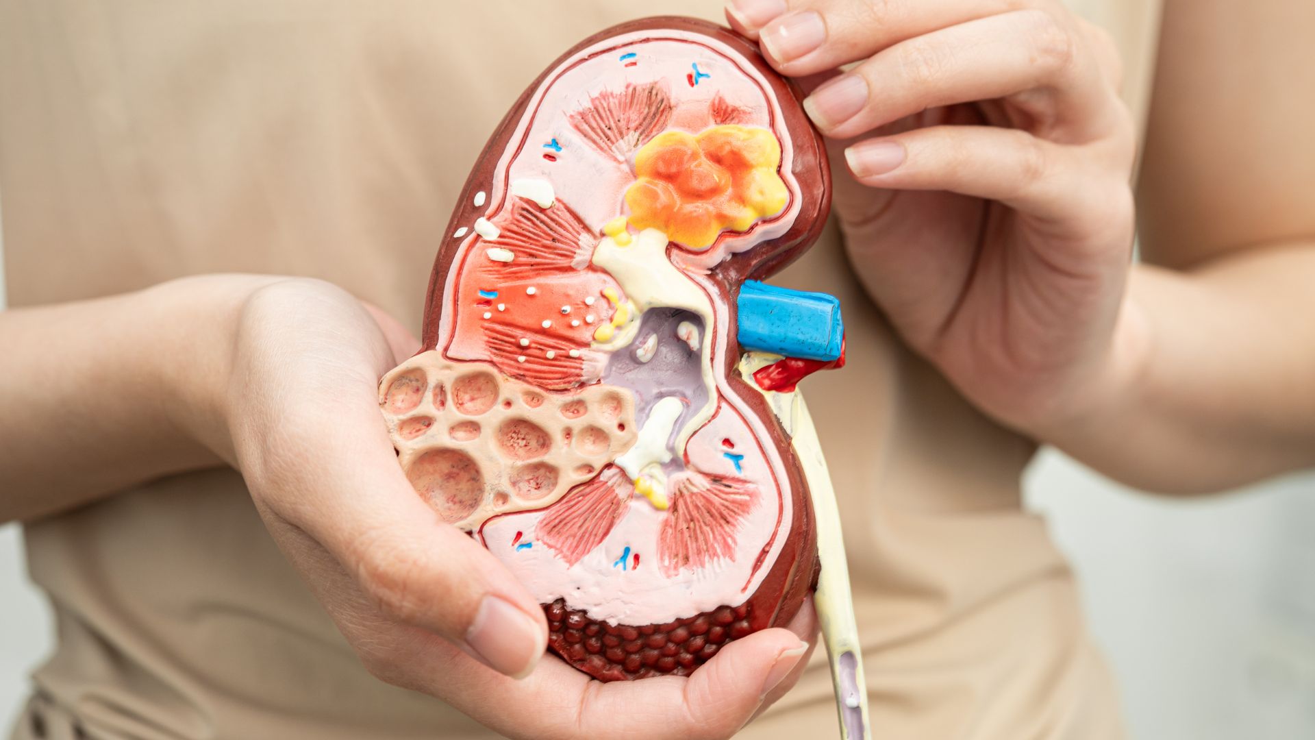 Thận ứ nước độ 2 là tình trạng nước tiểu bị ứ đọng ở trong thận mức độ trung bình