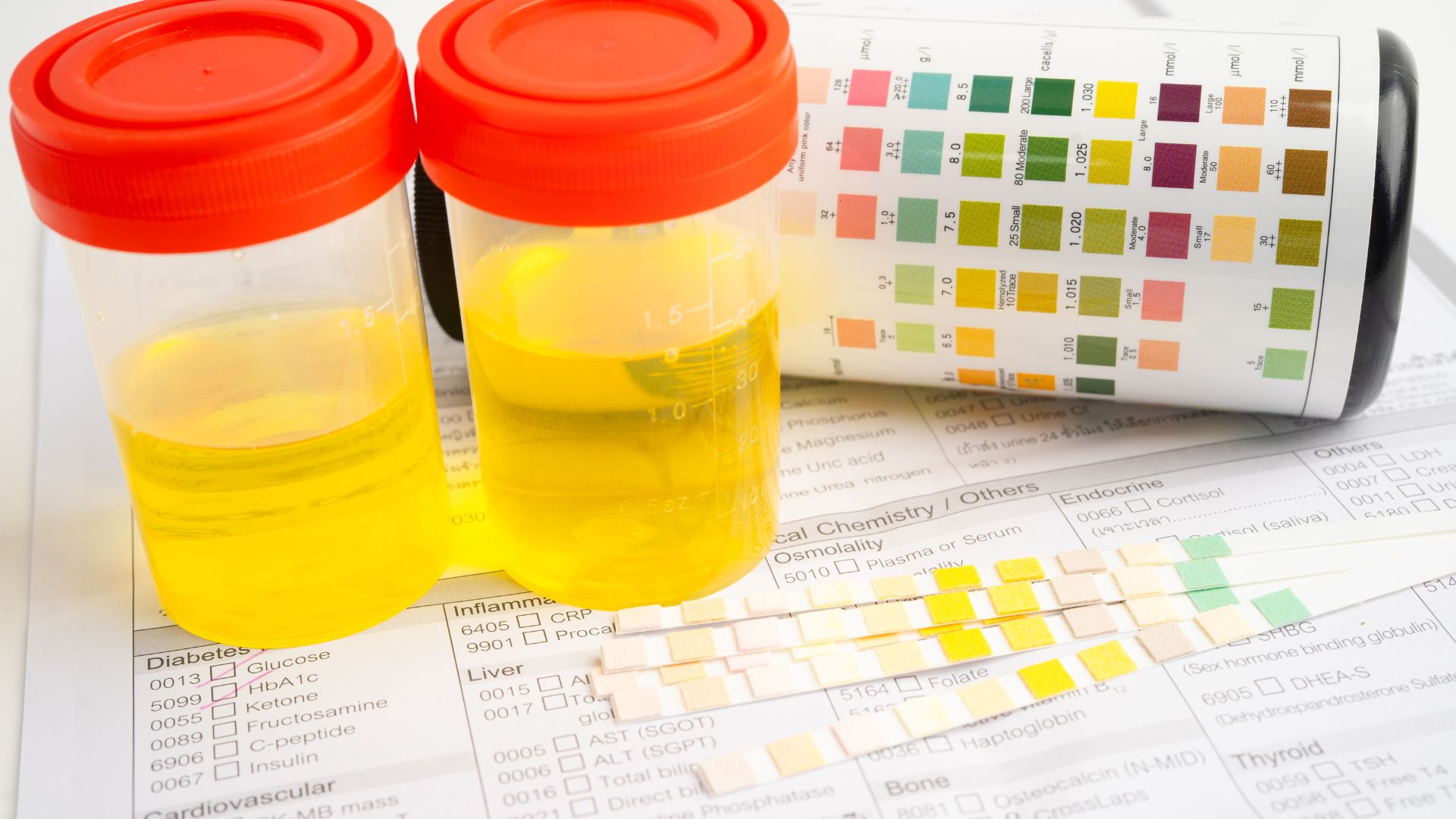 Nước tiểu bất thường là một dấu hiệu cảnh báo bệnh thận ứ nước