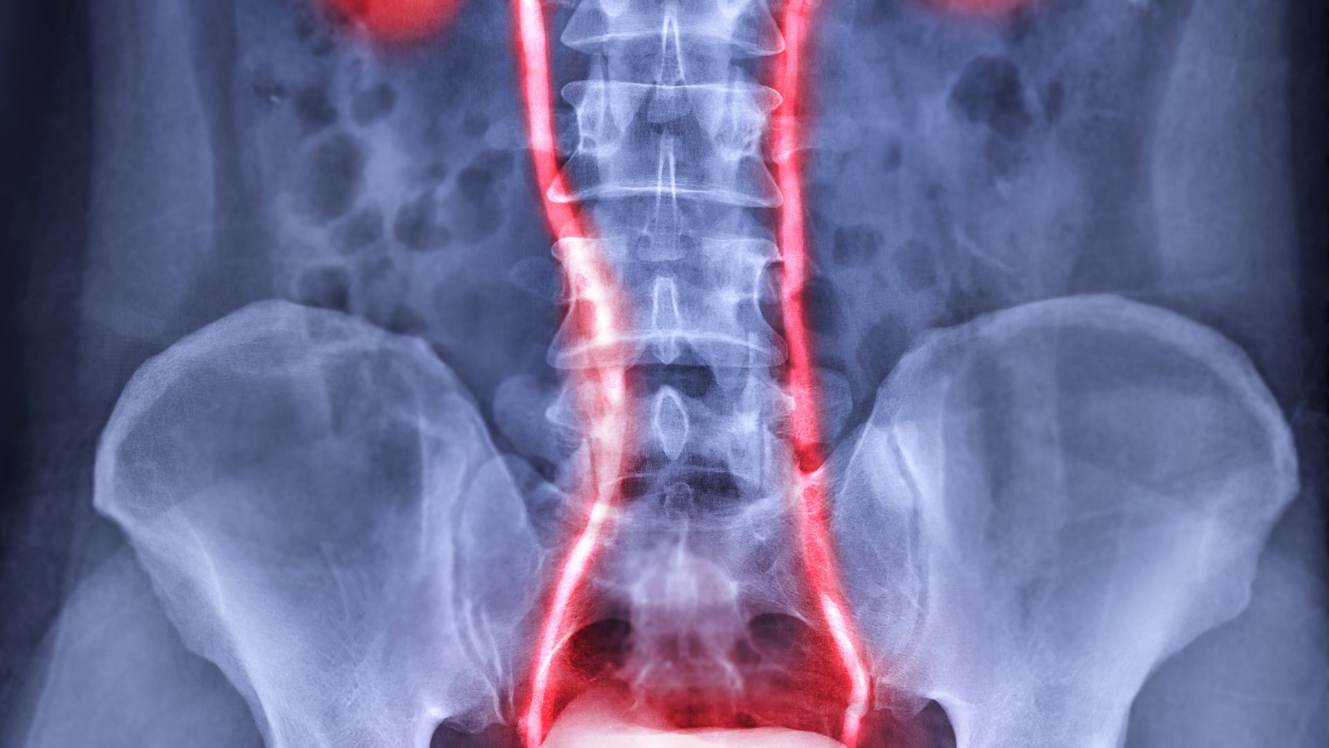 Tắc đường tiết niệu có thể gây ra tình trạng thận ứ nước