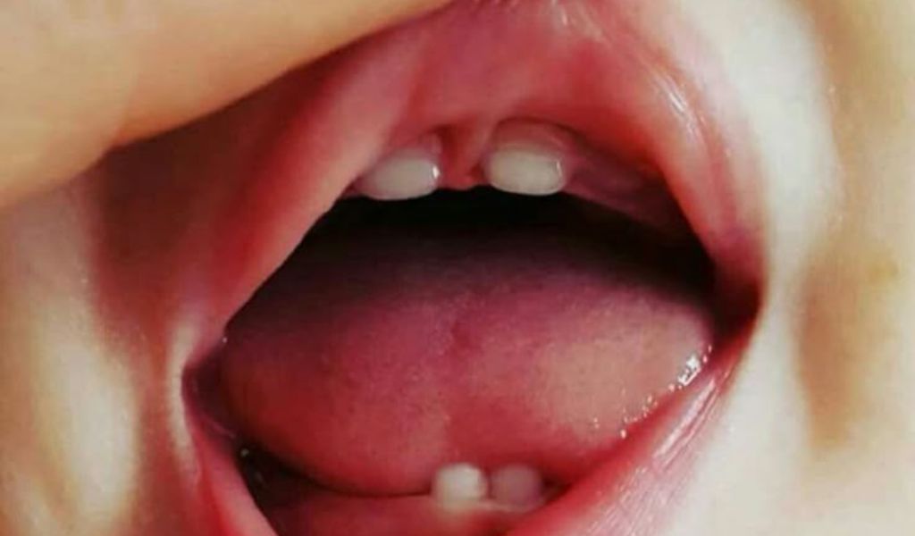 Dính thắng lưỡi môi trên là gì? Có ảnh hưởng đến sức khỏe không? 1