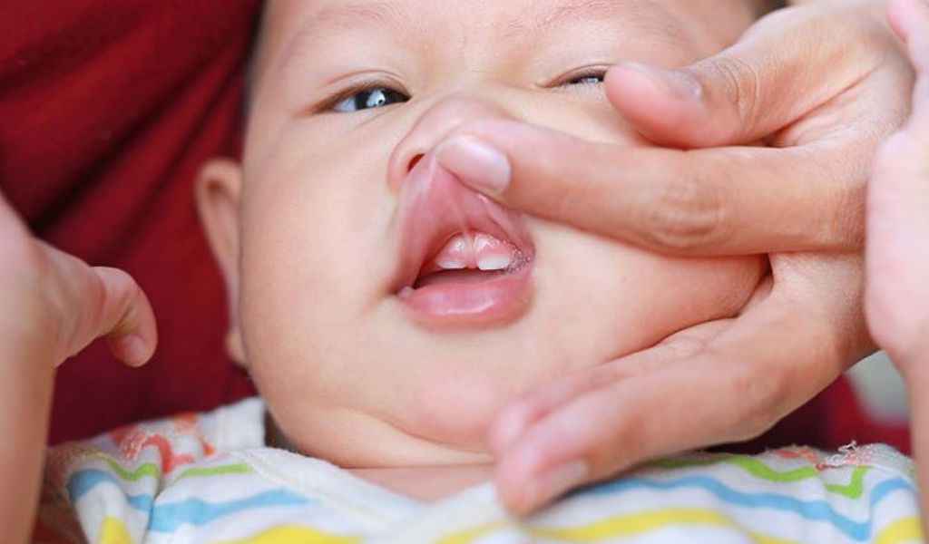 Dính thắng lưỡi môi trên là gì? Có ảnh hưởng đến sức khỏe không? 2