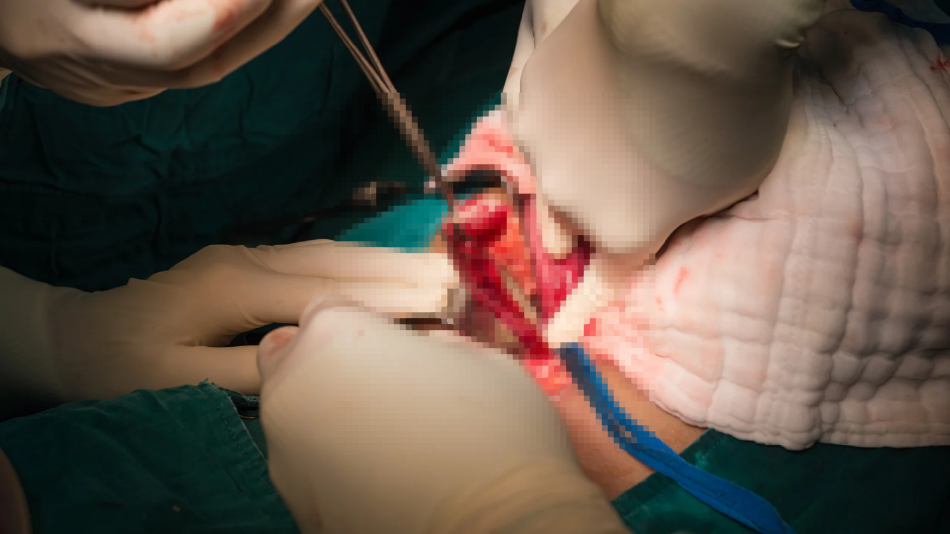 Chăm sóc vết mổ và theo dõi sức khỏe cẩn thận là những yếu tố quan trọng để phục hồi sau thủ thuật thắt ống dẫn trứng