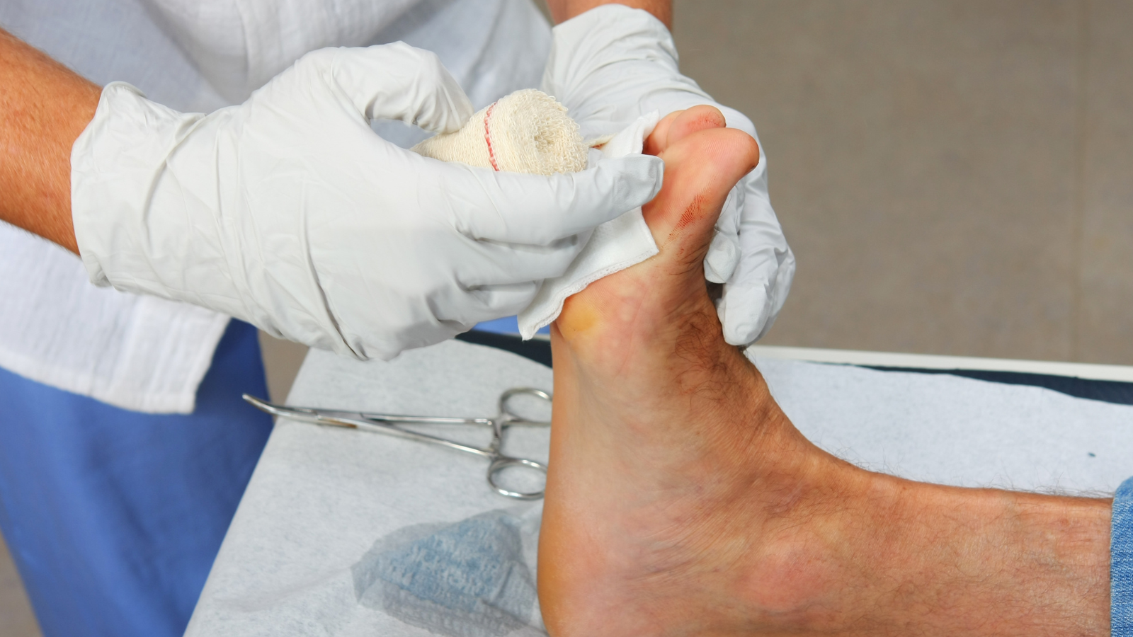 Mụn nhọt ở chân sưng đau: Làm sao để hết nhanh và không nhiễm trùng? 3