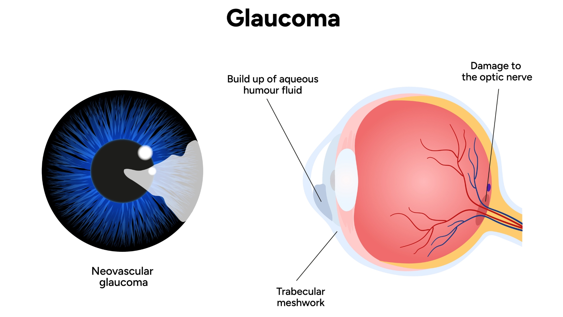 Trong bệnh glôcôm, sự mất cân bằng giữa sản xuất và dẫn lưu thủy dịch dẫn đến tăng áp lực nội nhãn, gây tổn thương thần kinh thị giác