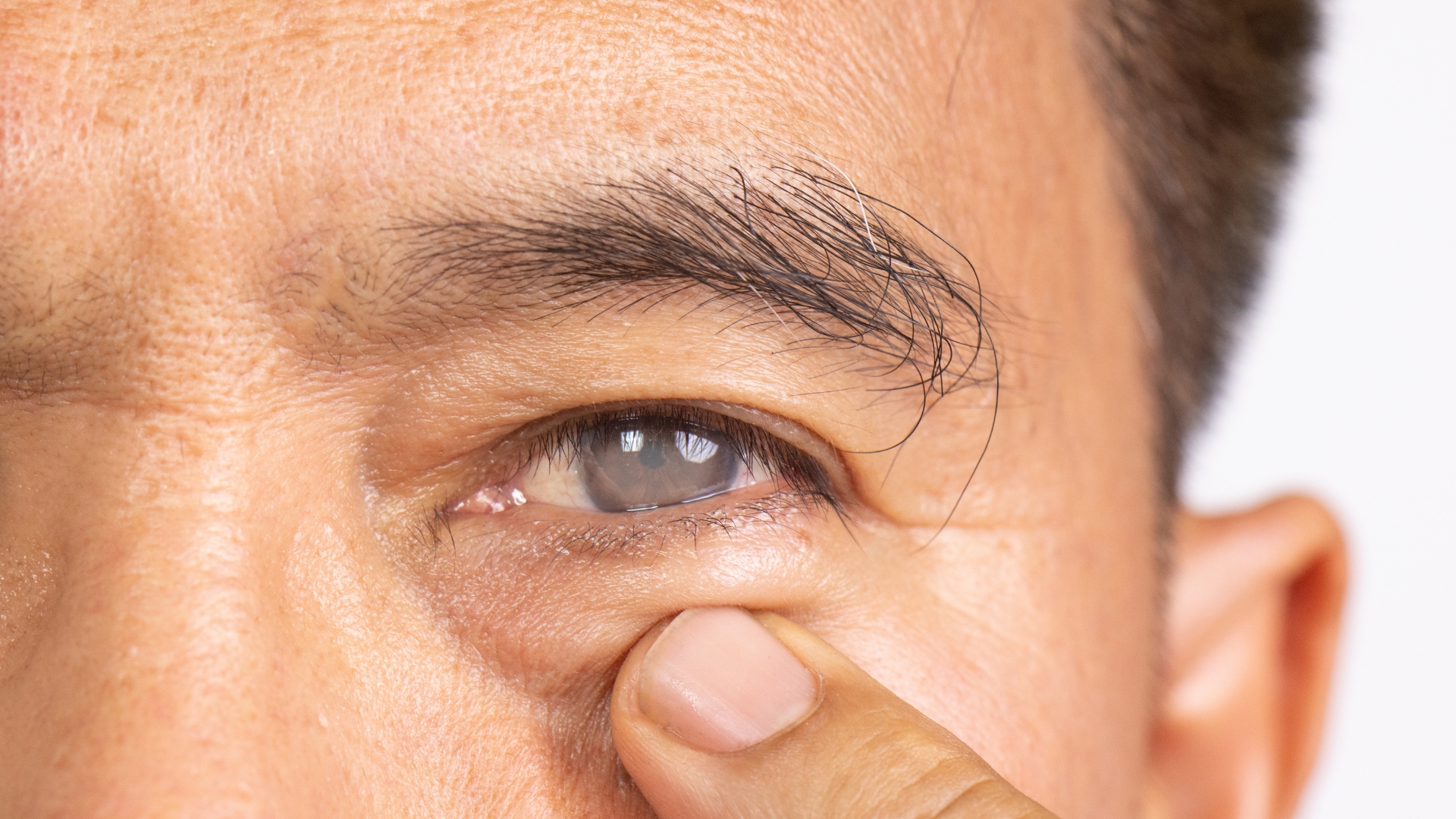 Đục thủy tinh thể là tình trạng thủy tinh thể bị mờ đục làm giảm lượng ánh sáng truyền đến võng mạc