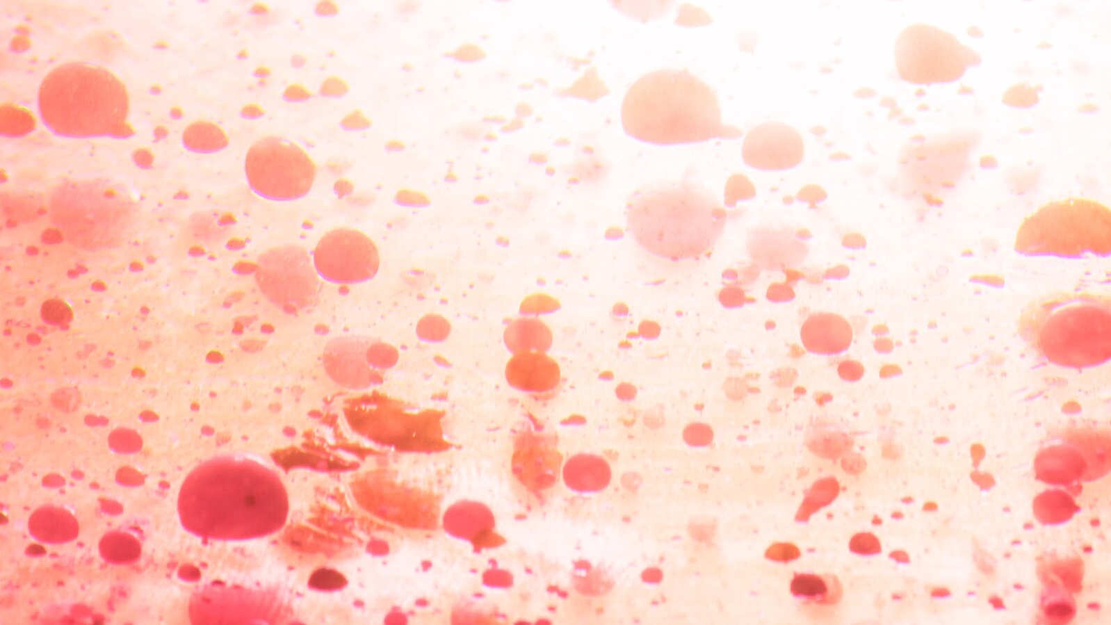 Thiếu máu hồng cầu nhỏ nhược sắc là một dạng thiếu máu trong đó các hồng cầu có kích thước nhỏ hơn bình thường và chứa ít hemoglobin nên màu nhạt