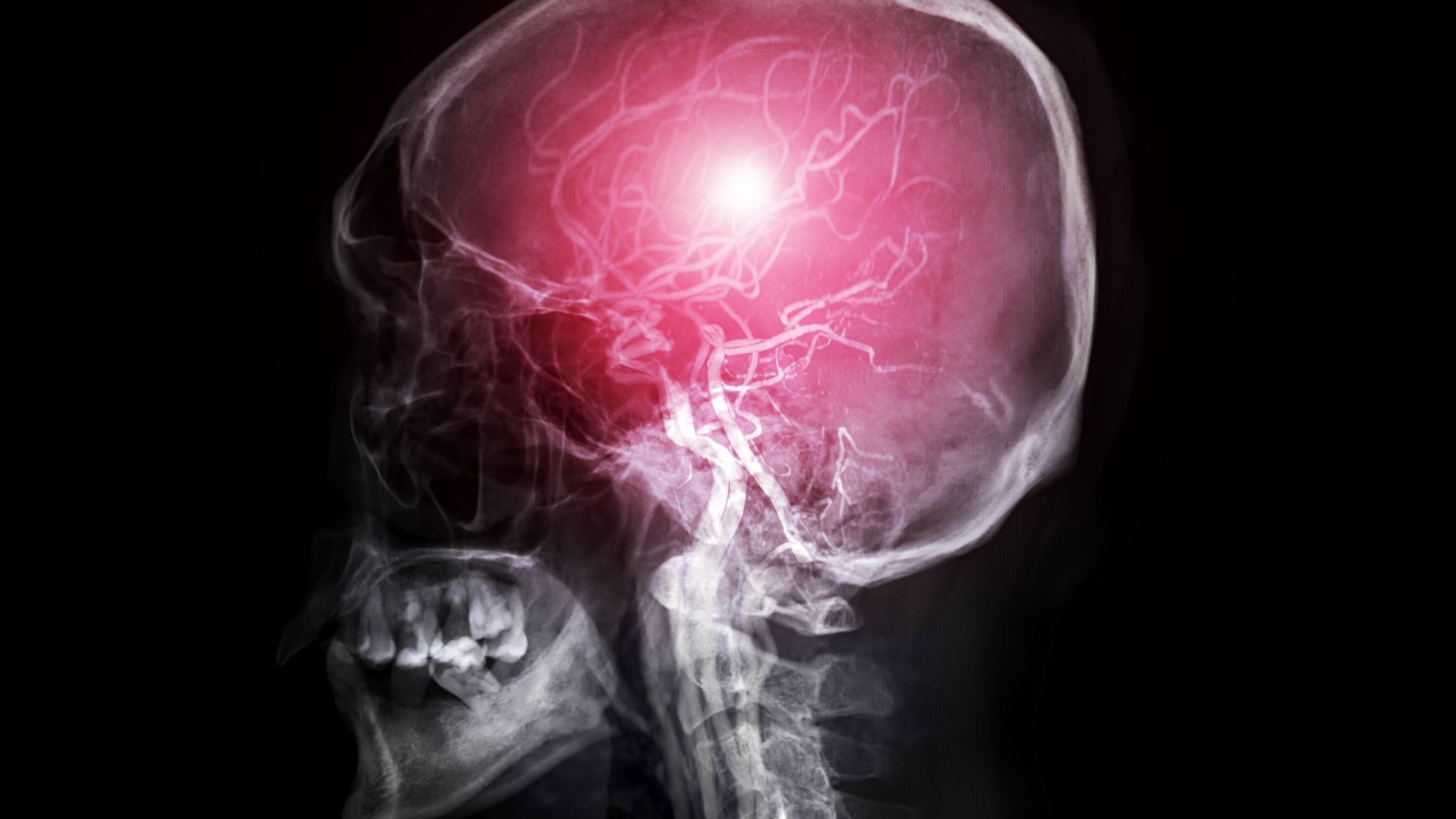 Thiếu oxy lên não có nguy hiểm không?