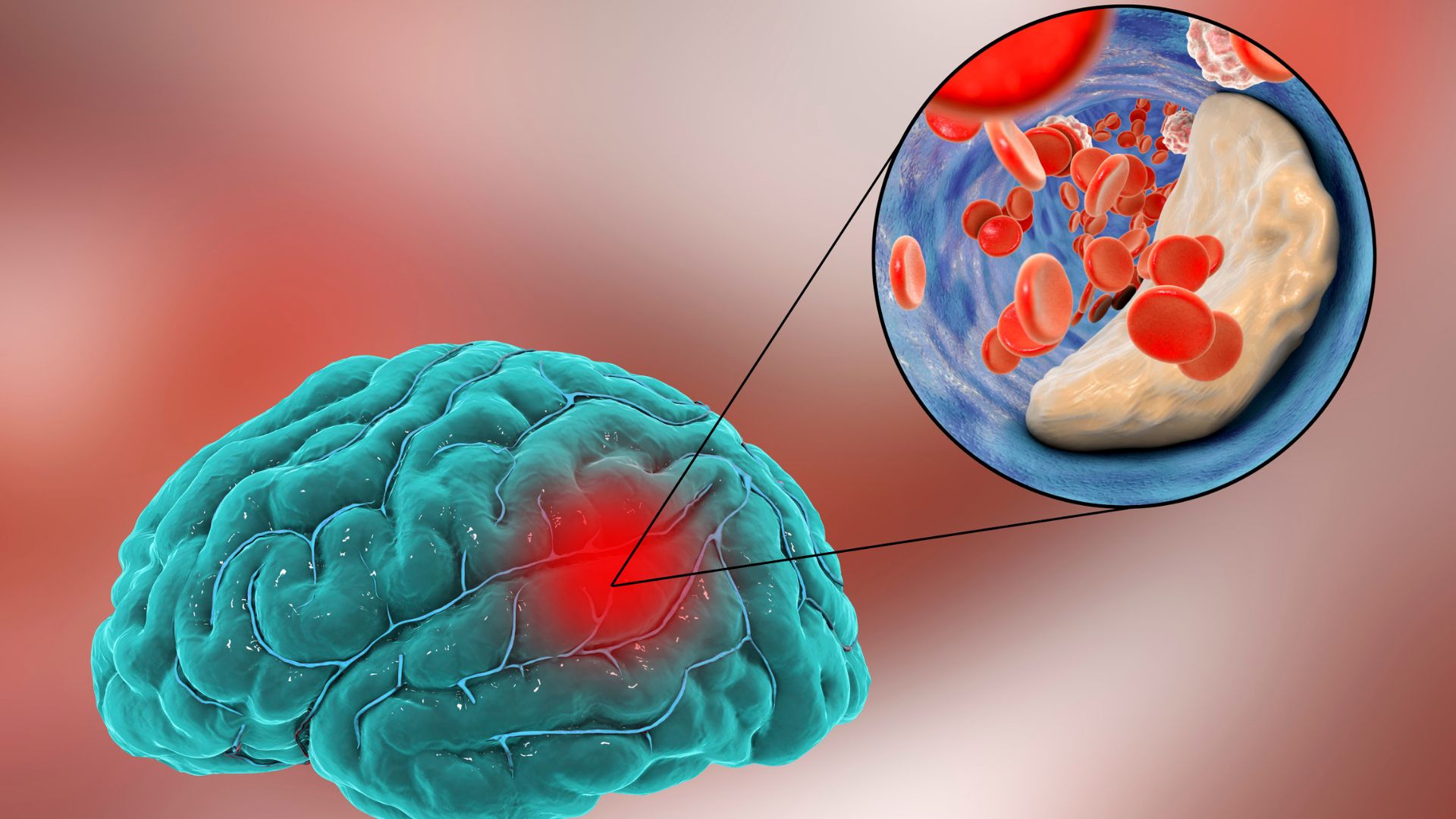 Não bị thiếu oxy có thể là do các bệnh lý mạch máu não