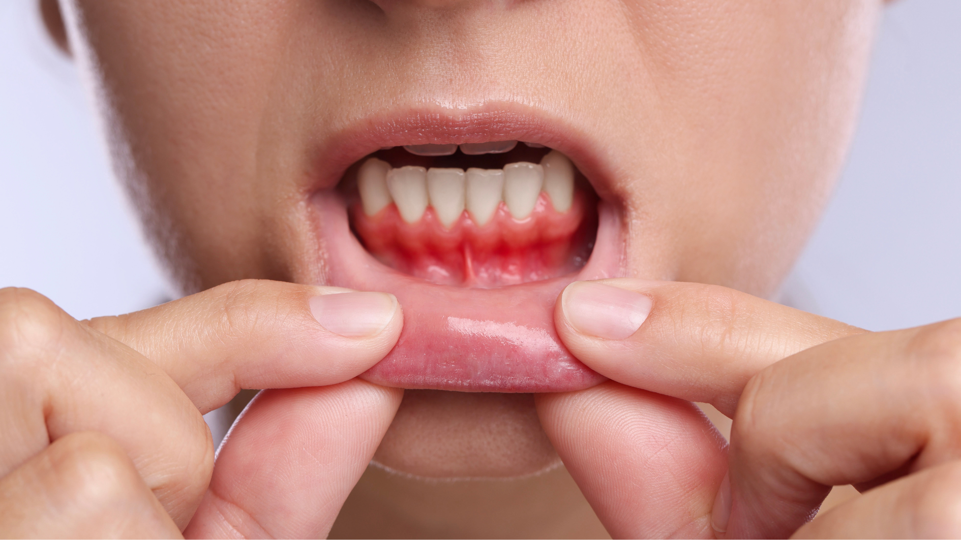 Thở bằng miệng lâu ngày có nguy cơ gây viêm nướu