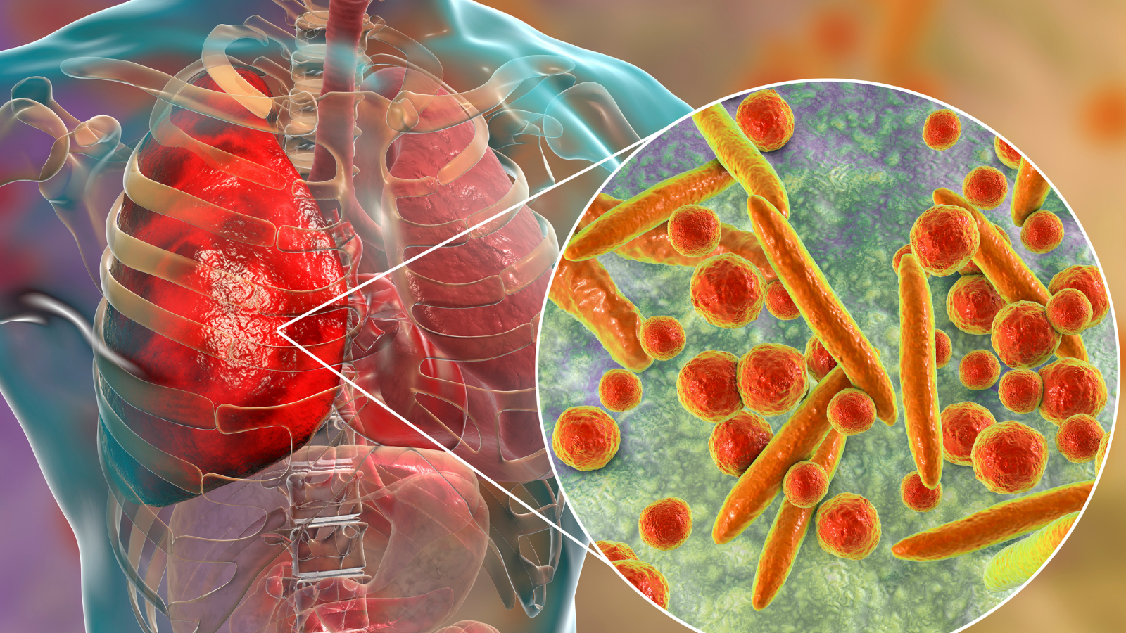 Các bệnh lý ở phổi như viêm phổi, viêm phế quản