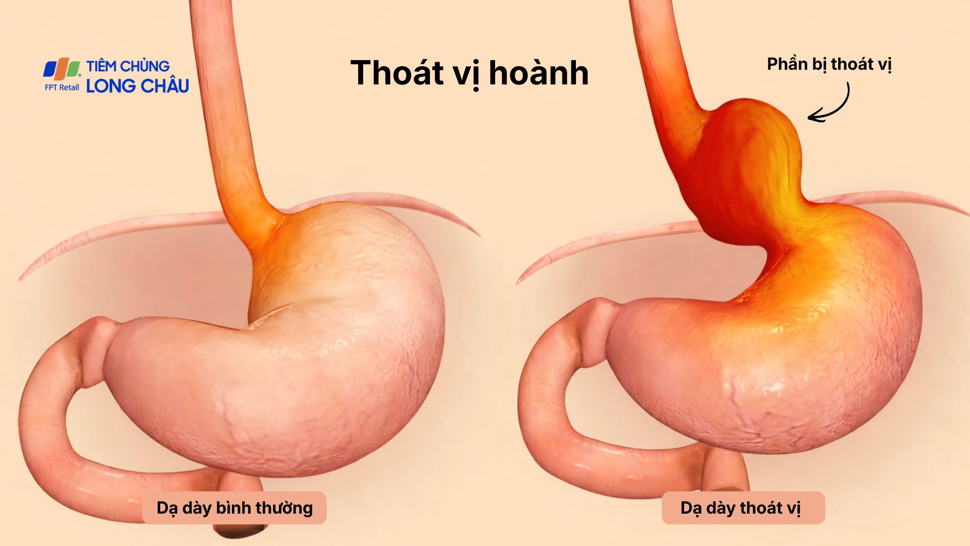 Thoát vị hoành xảy ra khi dạ dày hoặc các tạng ổ bụng di chuyển lên lồng ngực qua khe hở cơ hoành