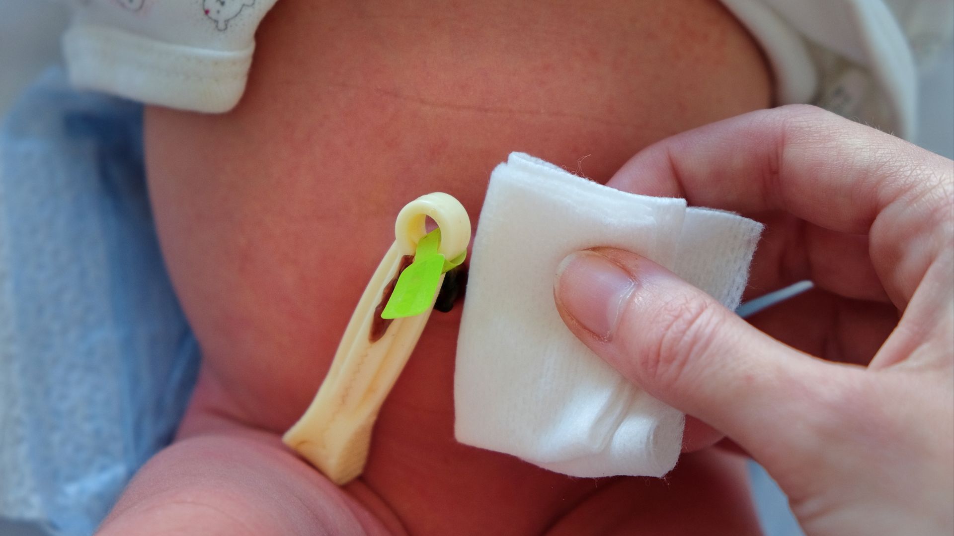 nguyên nhân chính xác gây thoát vị rốn ở thai nhi vẫn chưa được làm rõ