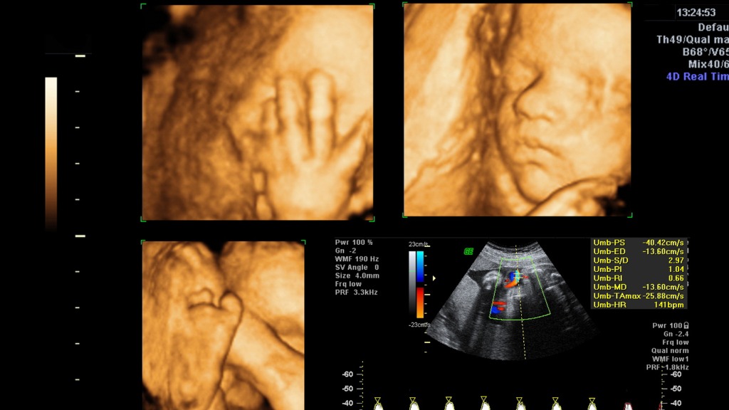 Siêu âm 4D giúp quan sát rõ nét các chuyển động và phản xạ của thai nhi