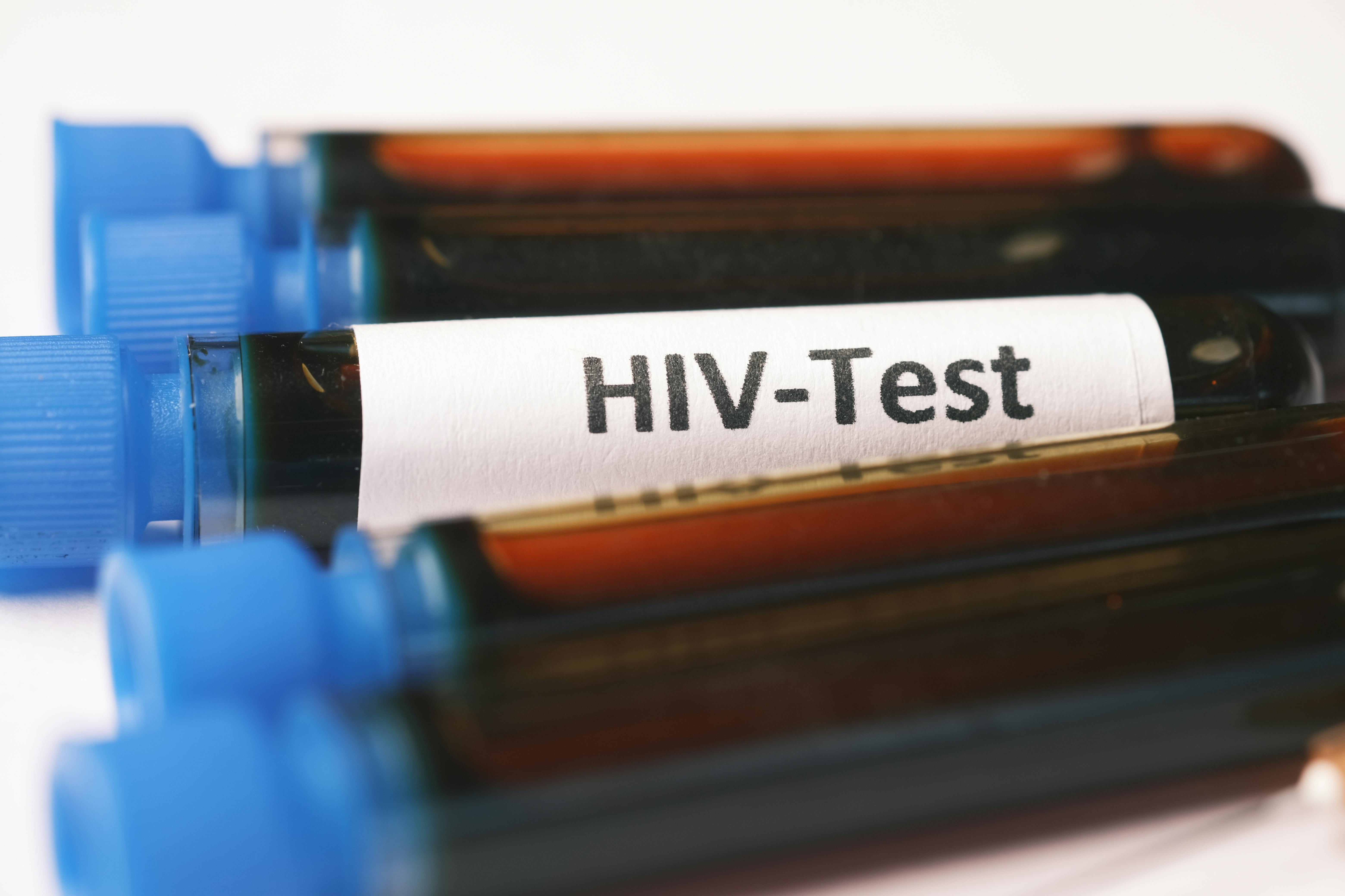 Thời điểm xét nghiệm HIV có kết quả chính xác là khi nào? Ai cần xét nghiệm HIV? 1