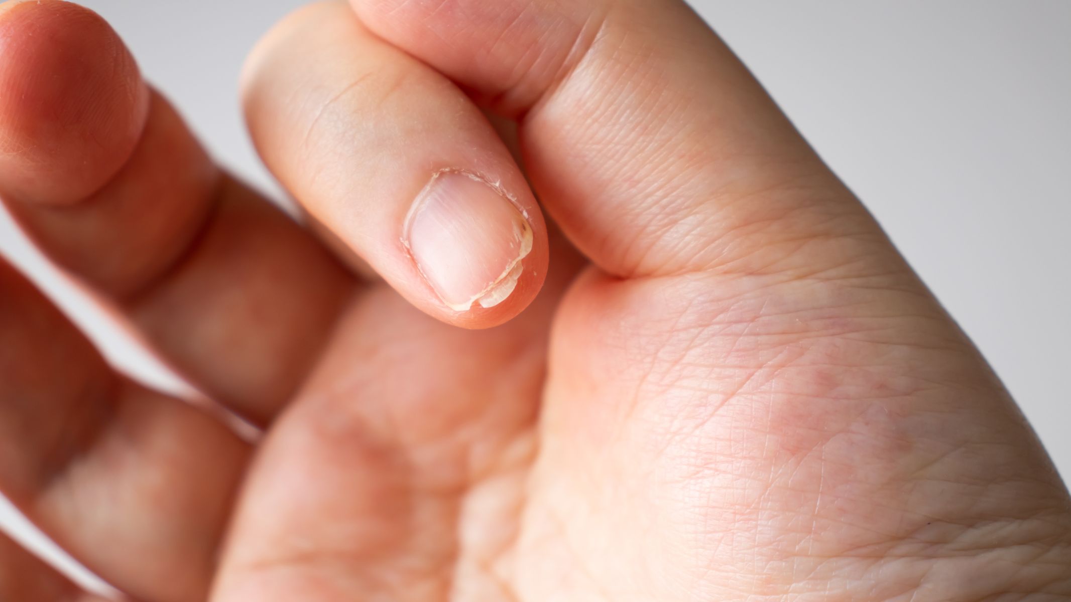 Thói quen cắn móng tay: Nguyên nhân và tác hại mà bạn cần biết 3