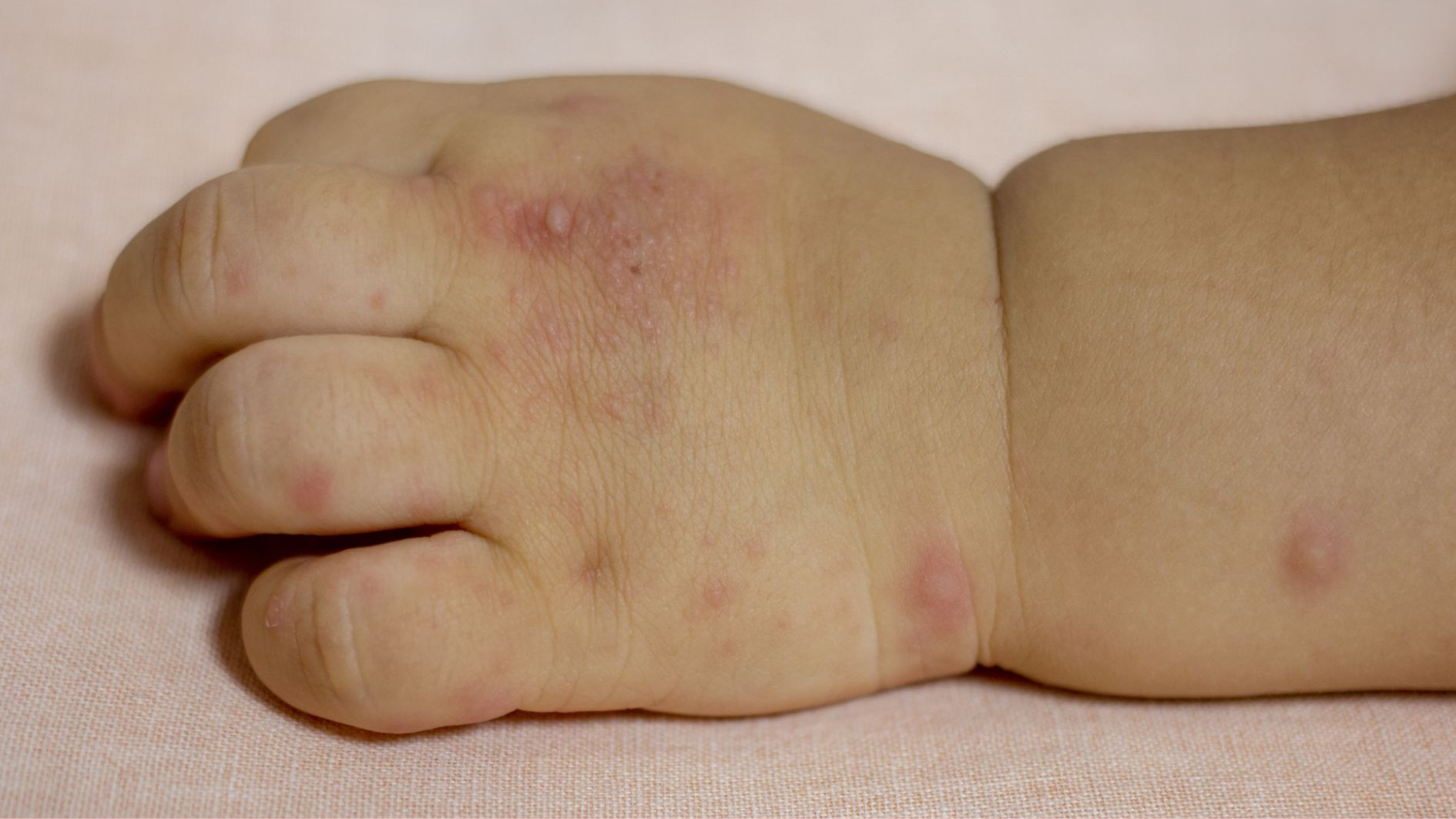 Cần nhận diện đúng tay chân miệng với các bệnh da liễu thường gặp