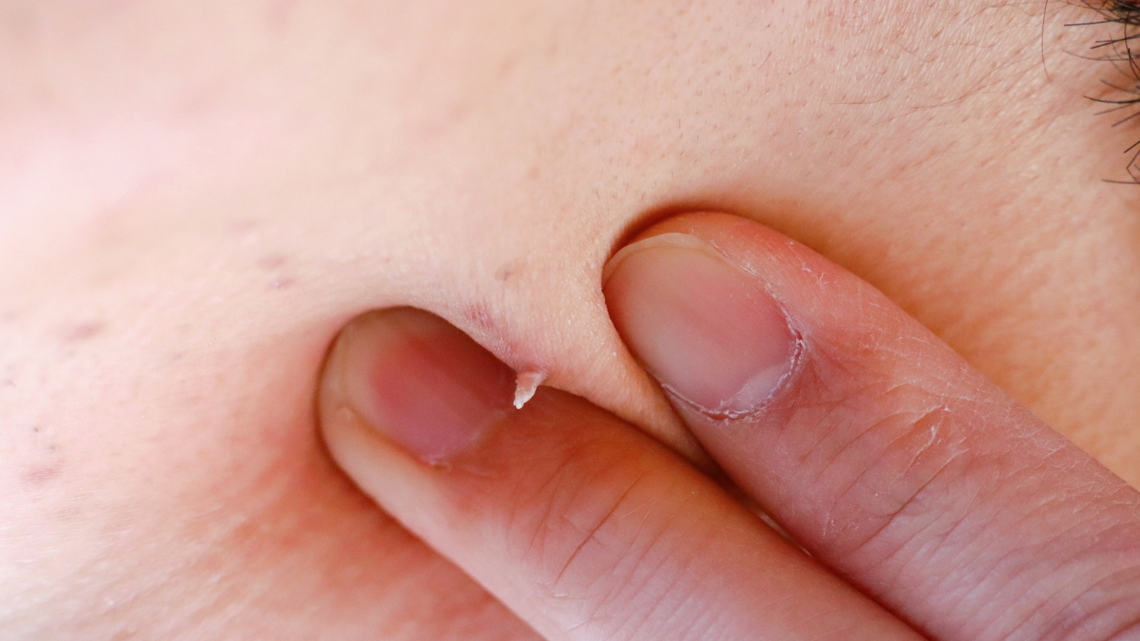 Quan sát thấy sự xuất hiện của các nốt u nhú hoặc nốt sần nhỏ li ti tại vùng kín