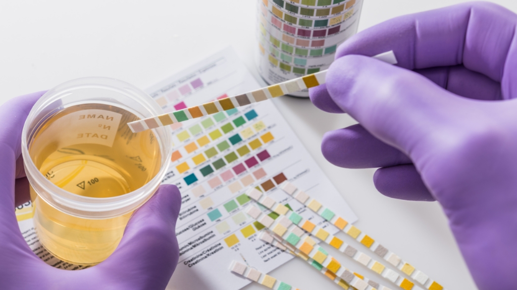 Các chỉ số thường gặp trong xét nghiệm nước tiểu ở người tiểu đường