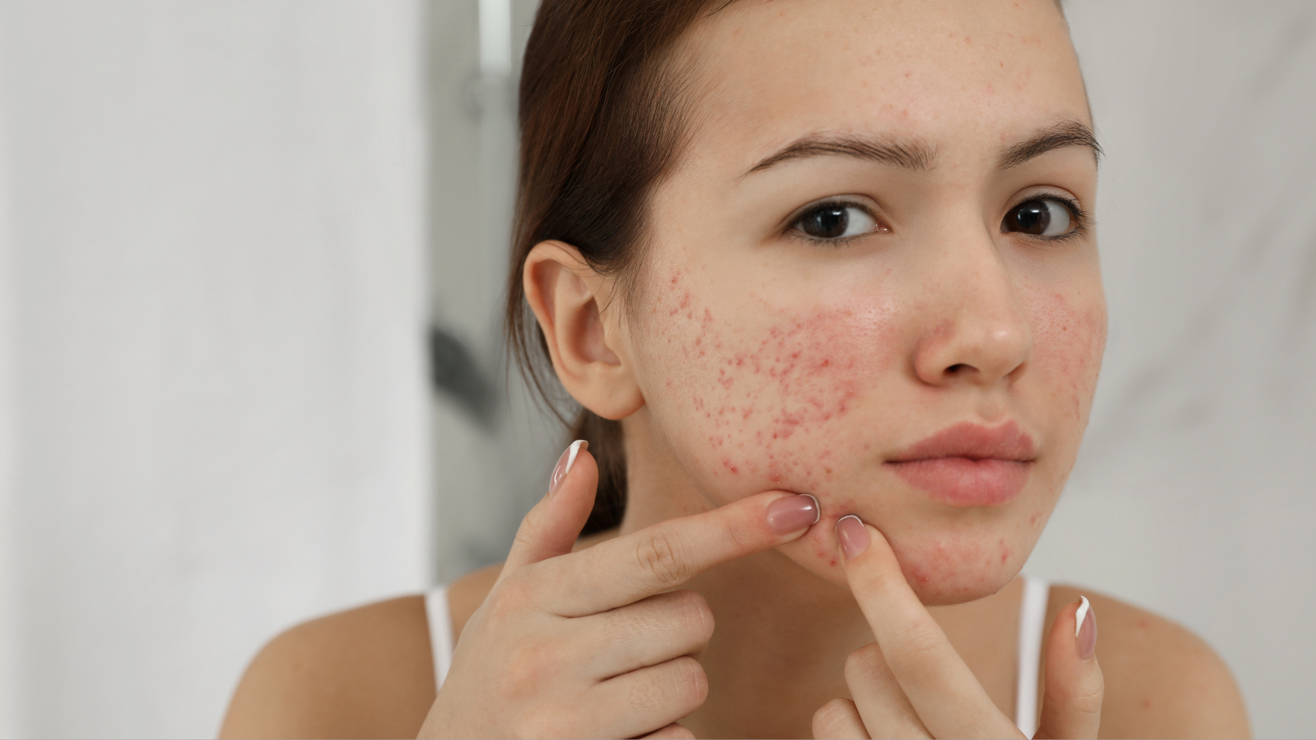 Thức khuya có nổi mụn không? Biện pháp cải thiện tình trạng da mụn 2